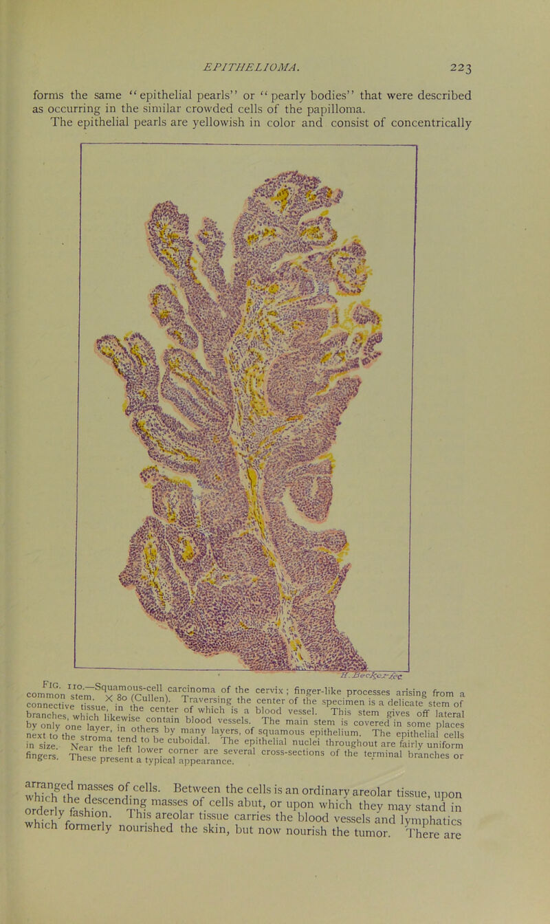 forms the same “epithelial pearls’’ or “pearly bodies’’ that were described as occurring in the similar crowded cells of the papilloma. The epithelial pearls are yellowish in color and consist of concentrically common\I,p'^Sq^TTS'?,el\Car^inoma.of the cervix: finger-hke processes arising from a connectivp ti ’ * -8° fallen). Traversing the center of the specimen is a delicate stem of branched w -he Center °f which is a blood vessel. This stem gives off TaTeral bv only one Iayer^n 'othe^Th'” bl°°di Vessels', The main stem is covered in some places next Jr , y 1 °thers by many layers, of squamous epithelium. The epithelia cells m sLe NeTr7hae ffwr CUb°idaL The CPitheliaI nucle> throughout are ffiyuniform fingers. & presit of *• inches or whkhthJTSCS °J-CCllS- Betw®en„the cells is an Quinary areolar tissue, upon which the descending masses of cells abut, or upon which they mav stand in orderly fashlo This areolar tissue carries the blood vessels a^d lymphatics which formerly nourished the skin, but now nourish the tumor. There are