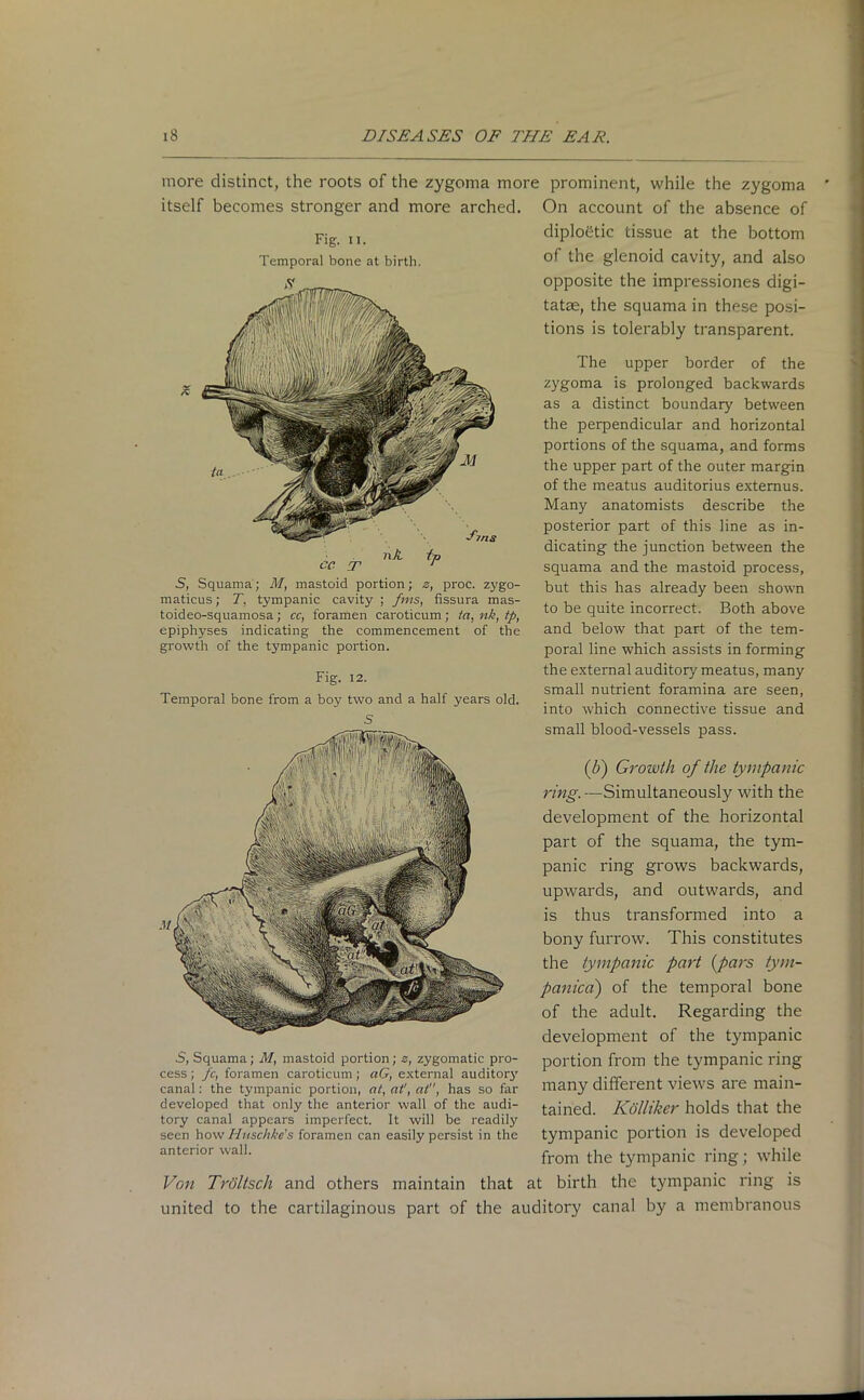 more distinct, the roots of the zygoma more prominent, while the zygoma itself becomes stronger and more arched. Fig. II. Temporal bone at birth. nA /p cc T r 5, Squama; M, mastoid portion; z, proc. zygo- maticus; T, tympanic cavity ; fms, fissura mas- toideo-squamosa; cc, foramen caroticum; ta, nk, tp, epiphyses indicating the commencement of the growth of the tympanic portion. Fig. 12. Temporal bone from a boy two and a half years old. S .$, Squama ; M, mastoid portion ; z, zygomatic pro- cess ; fc, foramen caroticum ; aG, external auditory canal: the tympanic portion, at, at', at, has so far developed that only the anterior wall of the audi- tory canal appears imperfect. It will be readily seen howHuschke’s foramen can easily persist in the anterior wall. Von Troltsch and others maintain that On account of the absence of diplodtic tissue at the bottom of the glenoid cavity, and also opposite the impressiones digi- tatae, the squama in these posi- tions is tolerably transparent. The upper border of the zygoma is prolonged backwards as a distinct boundary between the perpendicular and horizontal portions of the squama, and forms the upper part of the outer margin of the meatus auditorius extemus. Many anatomists describe the posterior part of this line as in- dicating the junction between the squama and the mastoid process, but this has already been shown to be quite incorrect. Both above and below that part of the tem- poral line which assists in forming the external auditory meatus, many small nutrient foramina are seen, into which connective tissue and small blood-vessels pass. (b) Growth of the tympanic ring.—Simultaneously with the development of the horizontal part of the squama, the tym- panic ring grows backwards, upwards, and outwards, and is thus transformed into a bony furrow. This constitutes the tympanic part (pars tym- panica) of the temporal bone of the adult. Regarding the development of the tympanic portion from the tympanic ring many different views are main- tained. Kolliker holds that the tympanic portion is developed from the tympanic ring; while at birth the tympanic ring is united to the cartilaginous part of the auditory canal by a membranous