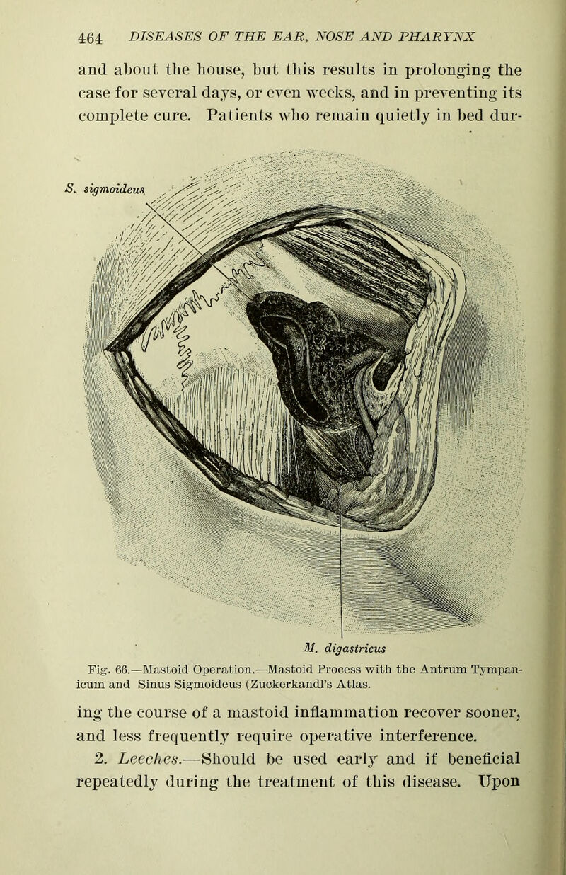 M. digastricus Fig1. 66.—Mastoid Operation.—Mastoid Process with the Antrum Tympan- icum and Sinus Sigmoideus (Zuckerkandl’s Atlas. ing the course of a mastoid inflammation recover sooner, and less frequently require operative interference. 2. Leeches.—Should be used early and if beneficial repeatedly during the treatment of this disease. Upon 464 DISEASES OF THE EAR, NOSE AND PHARYNX and about the house, but this results in prolonging the case for several days, or even weeks, and in preventing its complete cure. Patients who remain quietly in bed dur- S.
