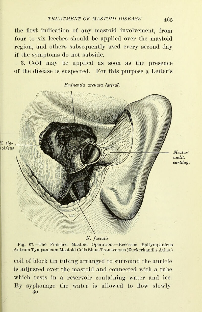 the first indication of any mastoid involvement, from four to six leeches should be applied over the mastoid region, and others subsequently used every second day if the symptoms do not subside. 3. Cold may be applied as soon as the presence of the disease is suspected. For this purpose a Leiter’s Eminentia arcuata. lateral.. Meatus' audit. cartilag. p. sig- wideus N. facialis Fig, 67.—The Finished Mastoid Operation.—Recessus Epitympanicus Antrum Tympanicum Mastoid Cells Sinus Transversus(ZuckerkandPs Atlas.) coil of block tin tubing arranged to surround the auricle is adjusted over the mastoid and connected with a tube which rests in a reservoir containing water and ice. By syphonage the water is allowed to flow slowly 80