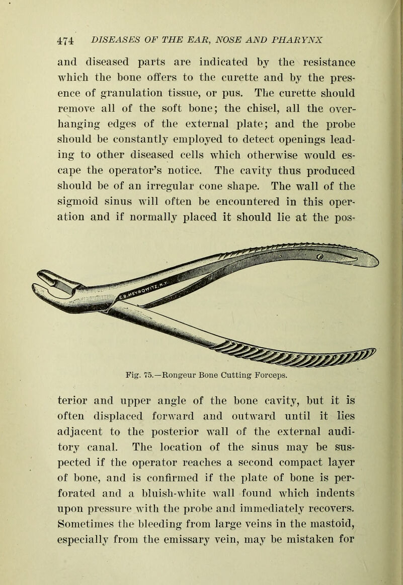 and diseased parts are indicated by the resistance which the bone offers to the curette and by the pres- ence of granulation tissue, or pus. The curette should remove all of the soft bone; the chisel, all the over- hanging edges of the external plate; and the probe should be constantly employed to detect openings lead- ing to other diseased cells which otherwise would es- cape the operator’s notice. The cavity thus produced should be of an irregular cone shape. The wall of the sigmoid sinus will often be encountered in this oper- ation and if normally placed it should lie at the pos- Fig. 75.—Rongeur Bone Cutting Forceps. terior and upper angle of the bone cavity, but it is often displaced forward and outward until it lies adjacent to the posterior wall of the external audi- tory canal. The location of the sinus may be sus- pected if the operator reaches a second compact layer of bone, and is confirmed if the plate of bone is per- forated and a bluish-white wall found which indents upon pressure with the probe and immediately recovers. Sometimes the bleeding from large veins in the mastoid, especially from the emissary vein, may be mistaken for