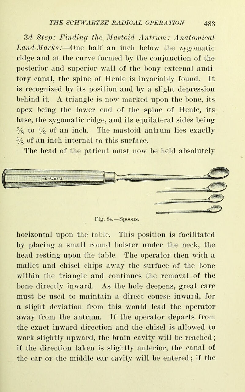 3(7 Step: Finding the Mastoid Antrum: Anatomical Land-Marks:—One half an inch below the zygomatic ridge and at the curve formed by the conjunction of the posterior and superior wall of the bony external audi- tory canal, the spine of Henle is invariably found. It is recognized by its position and by a slight depression behind it. A triangle is now marked upon the bone, its apex being the lower end of the spine of Henle, its base, the zygomatic ridge, and its equilateral sides being % to y2 of an inch. The mastoid antrum lies exactly % of an inch internal to this surface. The head of the patient must now be held absolutely horizontal upon the table. This position is facilitated by placing a small round bolster under the neck, the head resting upon the table. The operator then with a mallet and chisel chips away the surface of the bone within the triangle and continues the removal of the bone directly inward. As the hole deepens, great care must be used to maintain a direct course inward, for a slight deviation from this would lead the operator away from the antrum. If the operator departs from the exact inward direction and the chisel is allowed to work slightly upward, the brain cavity will be reached; if the direction taken is slightly anterior, the canal of the ear or the middle ear cavity will be entered; if the