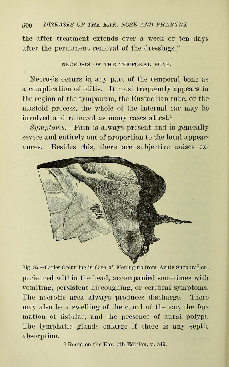 the after treatment extends over a week or ten days after the permanent removal of the dressings.” NECROSIS OF THE TEMPORAL BONE. Necrosis occurs in any part of the temporal hone as a complication of otitis. It most frequently appears in the region of the tympanum, the Eustachian tube, or the mastoid process, the whole of the internal ear may be involved and removed as many cases attest.1 Symptoms.—Pain is always present and is generally severe and entirely out of proportion to the local appear- ances. Besides this, there are subjective noises ex- Fig. 85.—Caries Occurring in Case of Meningitis from Acute Suppuration. perienced within the head, accompanied sometimes with vomiting, persistent hiccoughing, or cerebral symptoms. The necrotic area always produces discharge. There may also be a swelling of the canal of the ear, the for- mation of fistulae, and the presence of aural polypi. The lymphatic glands enlarge if there is any septic absorption. 1 Roosa on the Ear, 7tli Edition, p. 549.