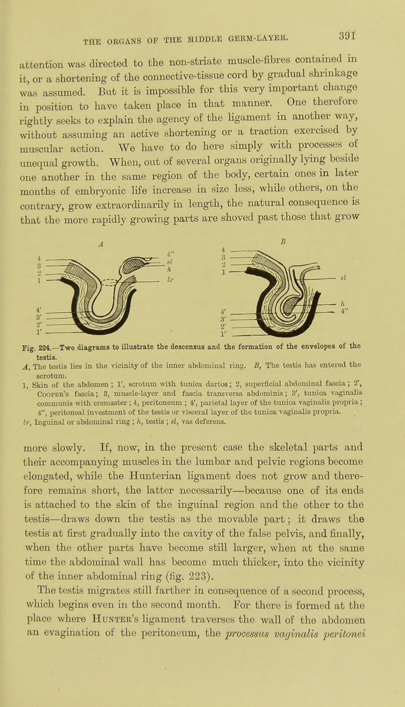 attention wa« dii-ected to the non-striate muscle-fibres contained m it, or a shortening of the connective-tissue cord by gradual shrinkage was assumed. But it is impossible for this very important change in position to have taken place in that manner. One therefore rightly seeks to explain the agency of the Ugament in another way, without assuming an active shortening or a traction exercised by muscular action. We have to do here simply with processes of unequal growth. When, out of several organs originally lying beside one another in the same region of the body, certain ones in later months of embryonic life increase in size less, while others, on the contrary, grow extraordinarily in length, the natural consequence is that the more rapidly growing parts are shoved past those that grow Fig. 224.—Two diagrams to illustrate the descensus and the formation of the envelopes of the testis. A, The testis lies in the vicinity of the inner abdominal ring. B, The testis has entered the scrotum. 1, Skin of the abdomen; 1', scrotum mth tunica dartos; 2, superficial abdominal fascia; 2', Cooper's fascia; 3, muscle-layer and fascia transversa abdominis; 3', tunica vaginalis communis with cremaster; 4, peritoneum ; 4', parietal layer of the tunica vaginalis proijria ; 4, peritoneal investment of the testis or visceral layer of the tunica vaginalis propria. if. Inguinal or abdominal ring; 7t, testis ; si, vaa deferens. more slowly. If, now, in the present case the skeletal parts and their accompanying muscles in the lumbar and pelvic regions become elongated, while the Hunterian hgament does not grow and there- fore remains short, the latter necessarily—because one of its ends is attached to the skin of the inguinal region and the other to the testis—draws down the testis as the movable part; it draws the testis at first gradually into the cavity of the false pelvis, and finally, when the other parts have become still larger, when at the same time the abdominal wall has become much thicker, into the vicinity of the inner abdominal ring (fig. 223). The testis migrates still farther in consequence of a second process, which begins even in the second month. For there is formed at the place where Hunter's ligament travei-ses the wall of the abdomen an evaginatiou of the peritoneum, the processios vaginalis po'ilonei