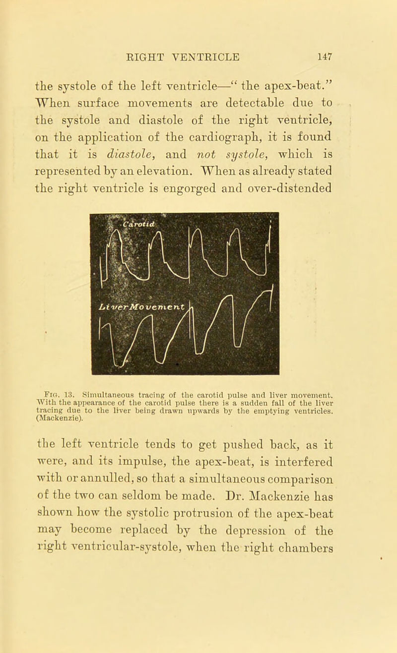 the systole of the left ventricle—“ the apex-heat.” When surface movements are detectable due to the systole and diastole of the right ventricle, on the application of the cardiograph, it is found that it is diastole, and not systole, which is represented by an elevation. When as already stated the right ventricle is engorged and over-distended Fig. 13. Simultaneous tracing of tlie carotid pulse and liver movement. With the appearance of the carotid pulse there is a sudden fall of the liver tracing due to the liver being drawn upwards by the emptying ventricles. (Mackenzie). the left ventricle tends to get pushed hack, as it were, and its impulse, the apex-heat, is interfered with or annulled, so that a simultaneous comparison of the two can seldom he made. Dr. Mackenzie has shown how the systolic protrusion of the apex-heat may become replaced by the depression of the right ventricular-systole, when the right chambers