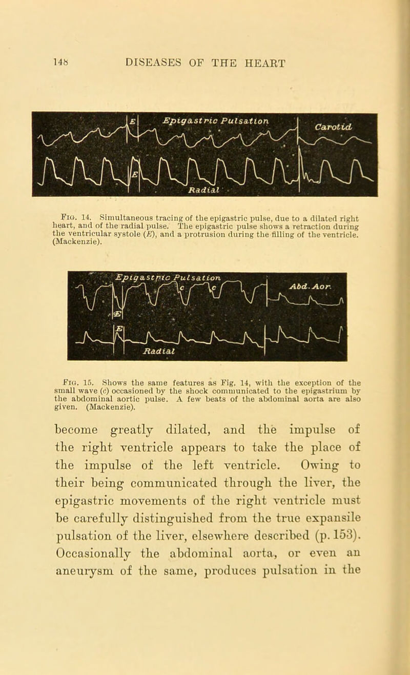 Fin. 14. Simultaneous tracing of the epigastric pulse, due to a dilated right heart, and of the radial pulse. The epigastric pulse shows a retraction during the ventricular systole (K), and a protrusion during the filling of the ventricle. (Mackenzie). Fio. 15. Shows the same features as Fig. 14, with the exception of the small wave (c) occasioned by the shock communicated to the epigastrium by the abdominal aortic pulse. A few beats of the abdominal aorta are also given. (Mackenzie). become greatly dilated, and the impulse of the right ventricle appears to take the place of the impulse of the left ventricle. Owing to their being communicated through the liver, the epigastric movements of the right ventricle must be carefully distinguished from the true expansile pulsation of the liver, elsewhere described (p. 153). Occasionally the abdominal aorta, or even an aneurysm of the same, produces pulsation in the