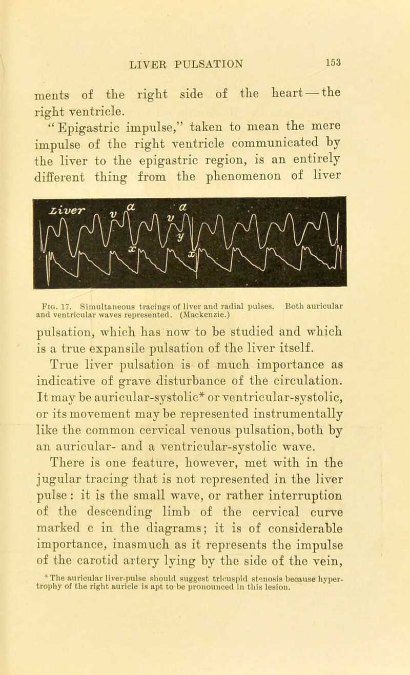LIVER PULSATION ments of the right side of the heart — the right ventricle. “Epigastric impulse,” taken to mean the mere impulse of the right ventricle communicated by the liver to the epigastric region, is an entirely different thing from the phenomenon of liver Fig. 17. Simultaneous tracings of liver and radial pulses. Both auricular and ventricular waves represented. (Mackenzie.) pulsation, which has now to be studied and which is a true expansile pulsation of the liver itself. True liver pulsation is of much importance as indicative of grave disturbance of the circulation. It may be auricular-systolic* or ventricular-systolic, or its movement maybe represented instrumentally like the common cervical venous pulsation, both by an auricular- and a ventricular-systolic wave. There is one feature, however, met with in the jugular tracing that is not represented in the liver pulse: it is the small wave, or rather interruption of the descending limb of the cervical curve marked c in the diagrams; it is of considerable importance, inasmuch as it represents the impulse of the carotid artery lying by the side of the vein, + The auricular llver-putae should suggest tricuspid stenosis beoau.se hyper- trophy of the right auricle is apt to be pronounced in this lesion.
