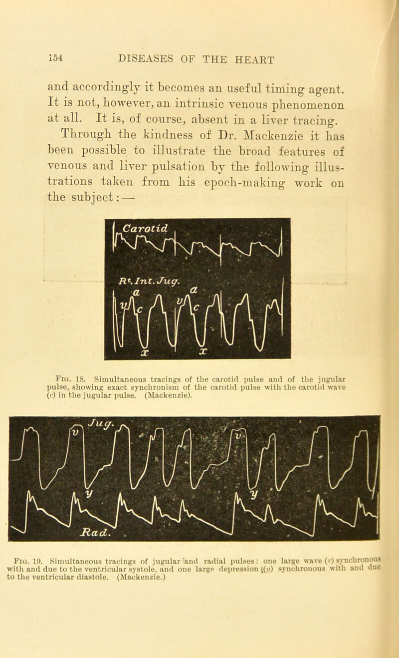 and accordingly it becomes an useful timing agent. It is not, however, an intrinsic venous phenomenon at all. It is, of course, absent in a liver tracing. I hrough the kindness of Dr. Mackenzie it has been possible to illustrate the broad features of venous and liver pulsation by the following illus- trations taken from his epoch-making work on the subject:— Fia. is. Simultaneous tracings of the carotid pulse and of the jugular pulse, showing exact synchronism of the carotid pulse with the carotid wave (c) in the jugular pulse. (Mackenzie). Fia. 19. Simultaneous tracings of jugular‘and radial pulses: one large wave (■•) synchronous with and due to the ventricular systole, and one large depression ((g) synchronous with and due to the ventricular diastole. (Mackenzie.)