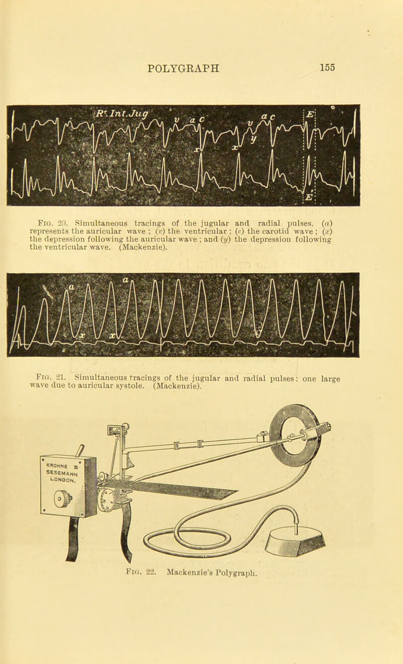 Fig. 20. Simultaneous tracings of the jugular and radial pulses, (a) represents the auricular wave ; (v) the ventricular ; (c) the carotid wave ; (x) the depression following the auricular wave ; and (//) the depression following the ventricular wave. (Mackenzie). Fig. 21. Simultaneous tracings of the jugular and radial pulses: one large wave due to auricular systole. (Mackenzie). KROHNE 5 SESEMANN UONOON. Fig. 22. Mackenzie’s Polygraph.