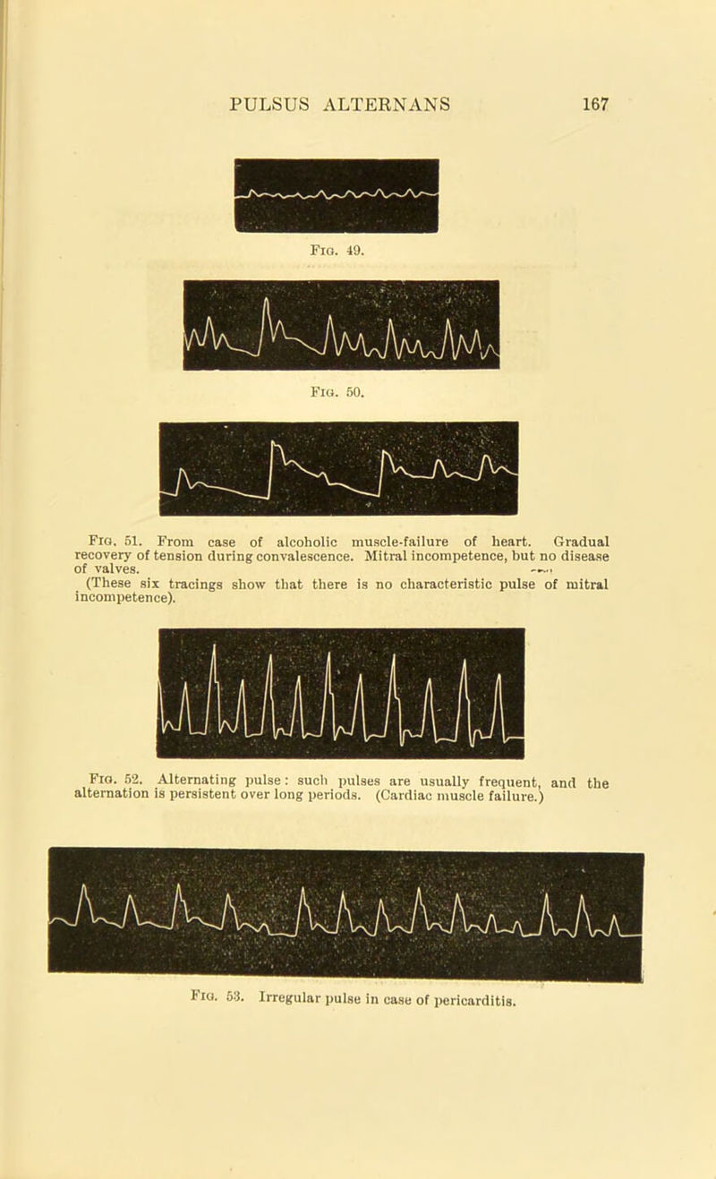Fig. 49. Fig. 50. Fig, 51. From case of alcoholic muscle-failure of heart. Gradual recovery of tension during convalescence. Mitral incompetence, but no disease of valves. —... (These six tracings show that there is no characteristic pulse of mitral incompetence). Fig. 52. Alternating pulse: such pulses are usually frequent, and the alternation is persistent over long periods. (Cardiac muscle failure.) Fig. 53. Irregular pulse in case of pericarditis.
