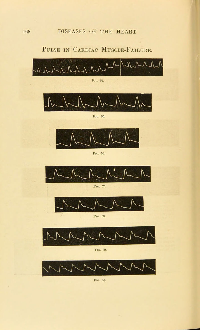 Pulse in Cardiac Muscle-Failure.