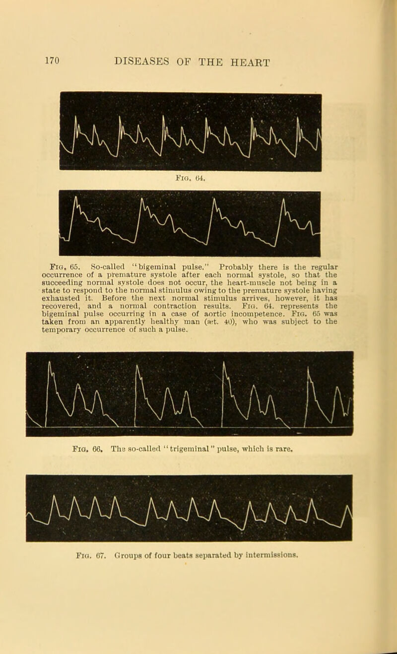 Fig. 04. Fig,6S. So-called “bigeminal pulse.” Probably there is the regular occurrence of a premature systole after each normal systole, so that the succeeding normal systole does not occur, the heart-muscle not being in a state to respond to the normal stimulus owing to the premature systole having exhausted it. Before the next normal stimulus arrives, however, it has recovered, and a normal contraction results. Fig. 64. represents the bigeminal pulse occurring in a case of aortic incompetence. Fig. 6S was taken from an apparently healthy man (set. 40), who was subject to the temporary occurrence of such a pulse. Flo. 66. The so-called “trigeminal’’ pulse, which is rare. Fig. 67. Groups of four beats separated by intermissions.