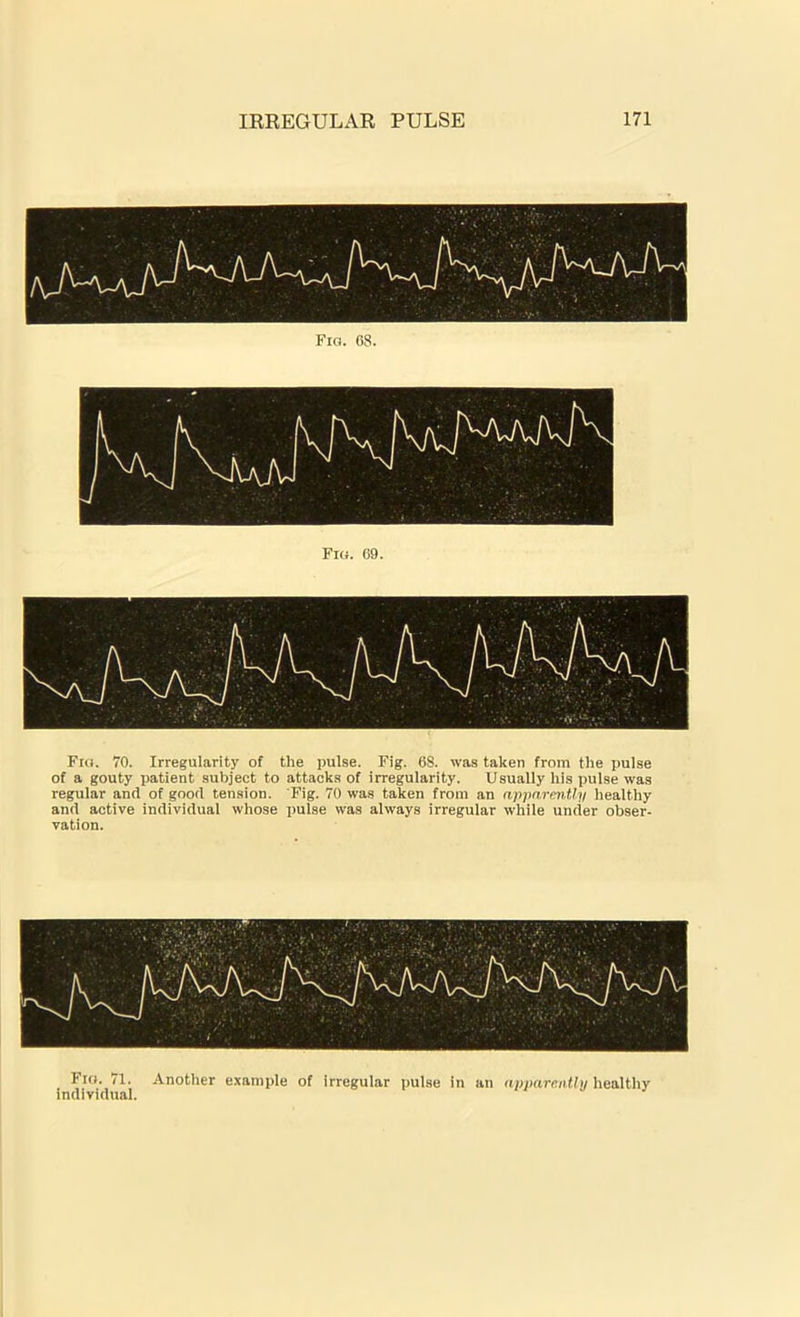 Fig. G8. Fig. 69. Fig. 70. Irregularity of the pulse. Fig. 6S. was taken from the pulse of a gouty patient subject to attacks of irregularity. Usually his pulse was regular and of good tension. Fig. 70 was taken from an apparently healthy and active individual whose pulse was always irregular while under obser- vation. Fig. 71. individual. Another example of irregular pulse in an apparently healthy