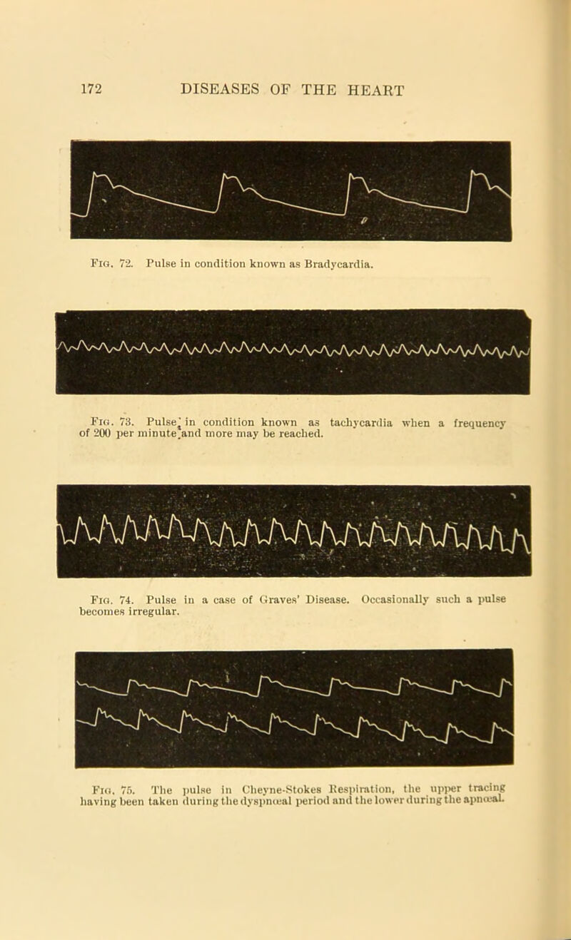 Fig, 72. Pulse in condition known as Bradycardia. Fig. 73. Pulse.) in condition known as tachycardia when a frequency of 200 per minute.and more may be reached. Fig. 74. Pulse in a case of Graves' Disease. Occasionally such a pulse becomes irregular. Fig, 76. The pulse in Cheyne-Stokes Respiration, the upper tracing having been taken during the dyspmeal period and the lower during the apnceah