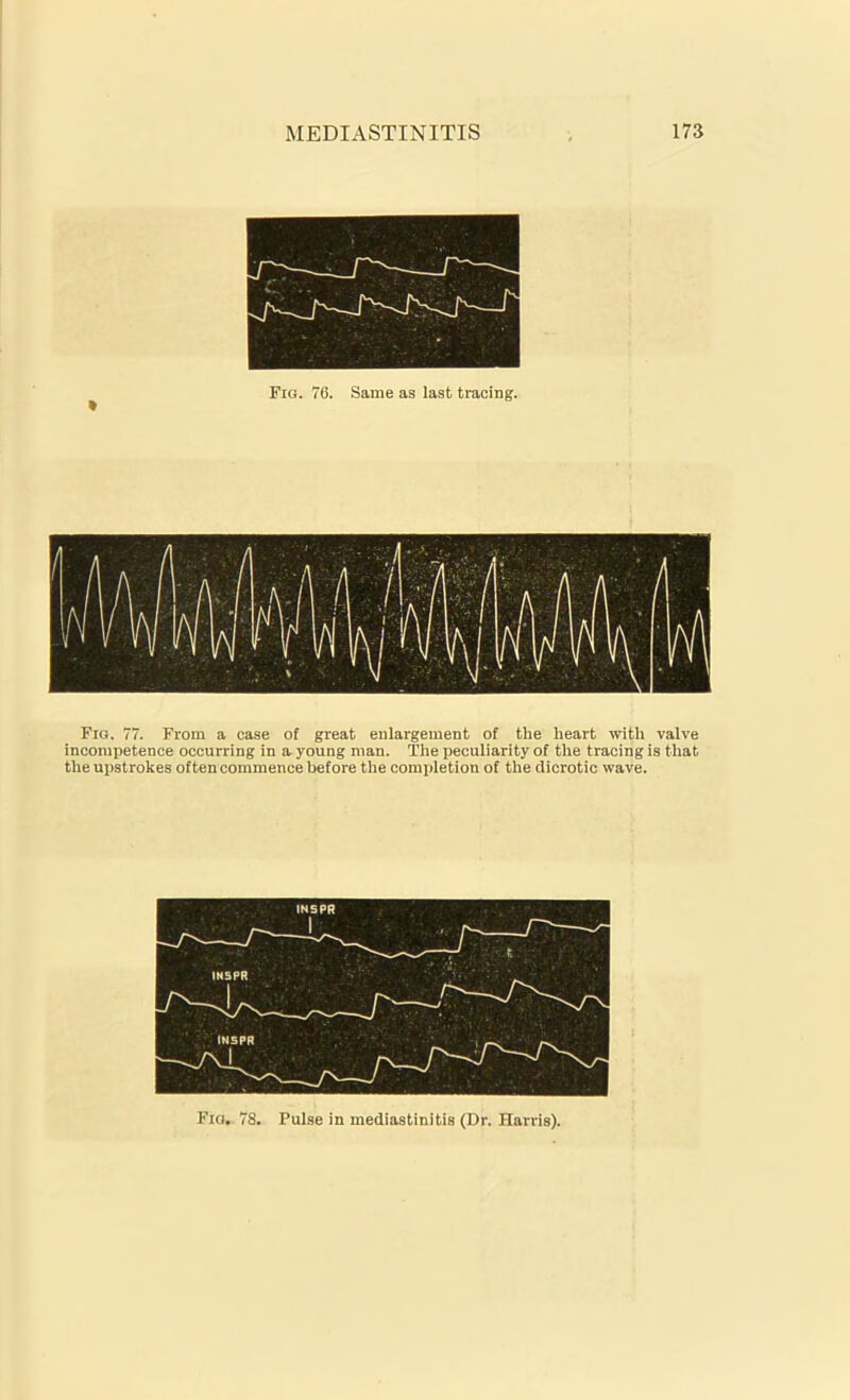 Fig. 76. Same as last tracing. Fig. 77. From a case of great enlargement of the heart with valve incompetence occurring in a young man. The peculiarity of the tracing is that the upstrokes often commence before the completion of the dicrotic wave. Fia. 78. Pulse in mediastinitis (Dr. Harris).