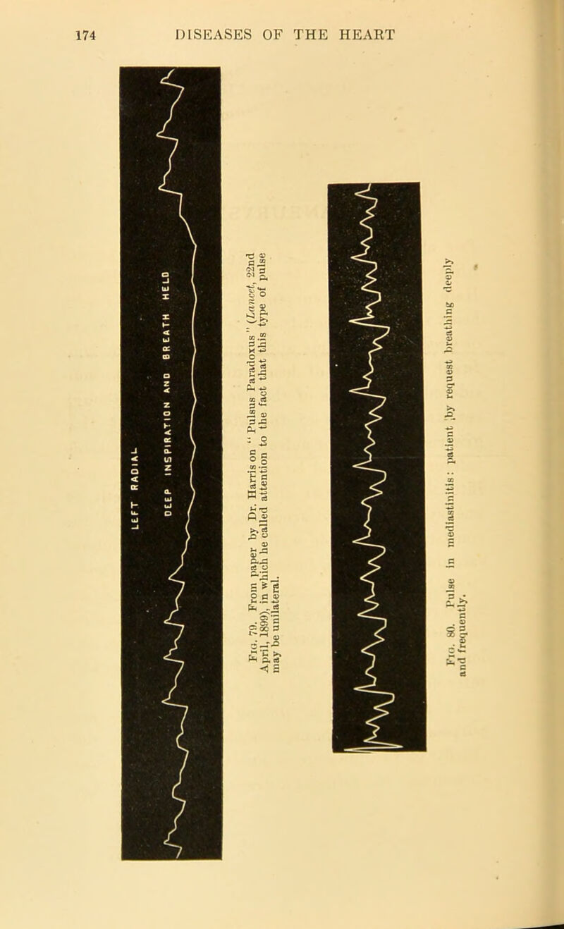 LE.FT RADIAL- Fio. 80. Pulse In mediastinltis: patient iby request breathing deeply and frequently.