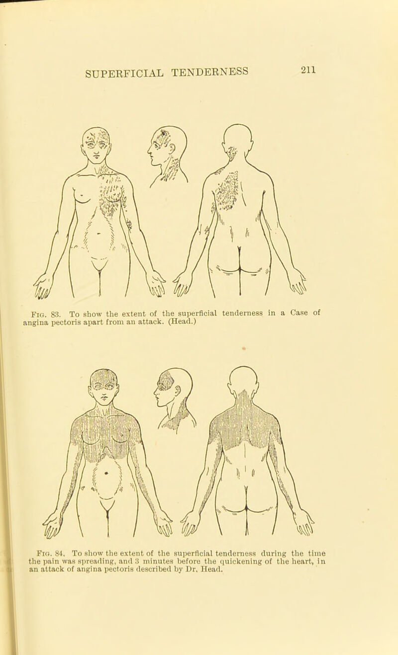 SUPERFICIAL TENDERNESS Fig. 83. To show the extent of the superficial tenderness in a Case of angina pectoris apart from an attack. (Head.) Fig. 84. To show the extent of the superficial tenderness during the time the pain was spreading, and 3 minutes before the quickening of the heart, in an attack of angina pectoris described by Dr, Head.