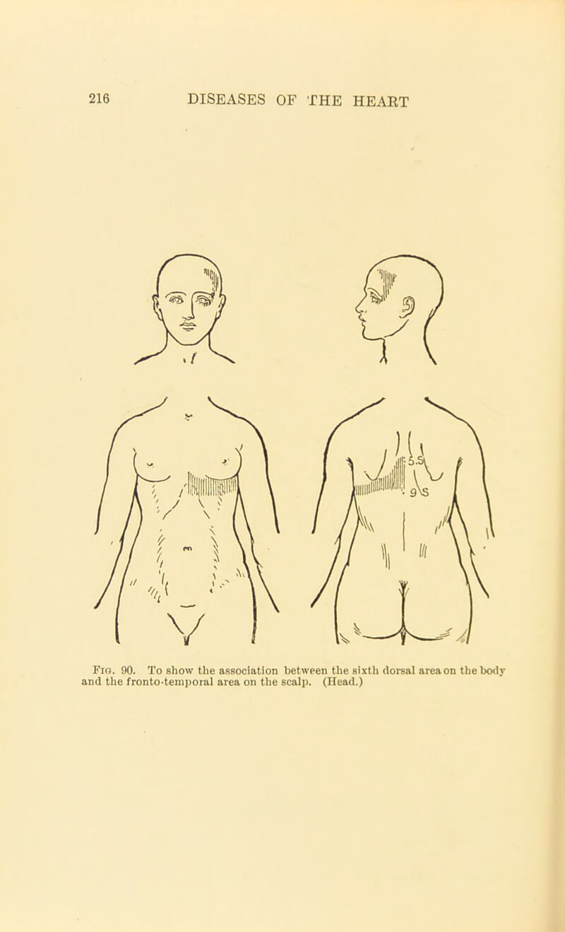 Fig. 90. To show the association between the sixth dorsal area on the body and the fronto-temporal area on the scalp. (Head.)