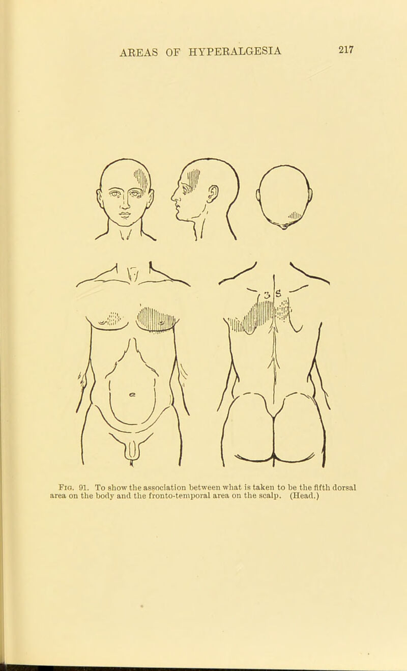 Fig. 91. To show the association between what is taken to be the fifth dorsal area on the body and the fronto-temporal area on the scalp. (Head.)