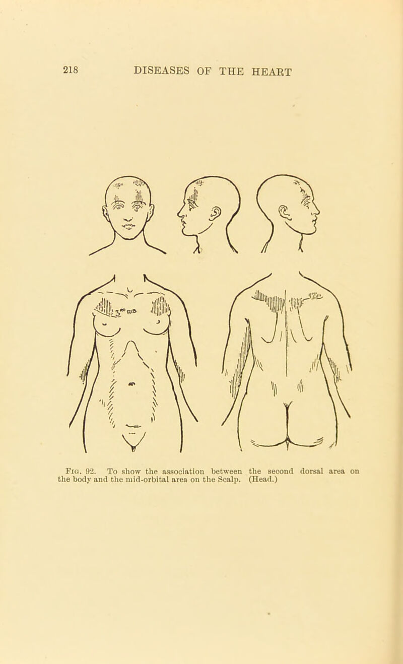 Fig. 92. To show the association between the second dorsal area on the body and the mid-orbital area on the Scalp. (Head.)
