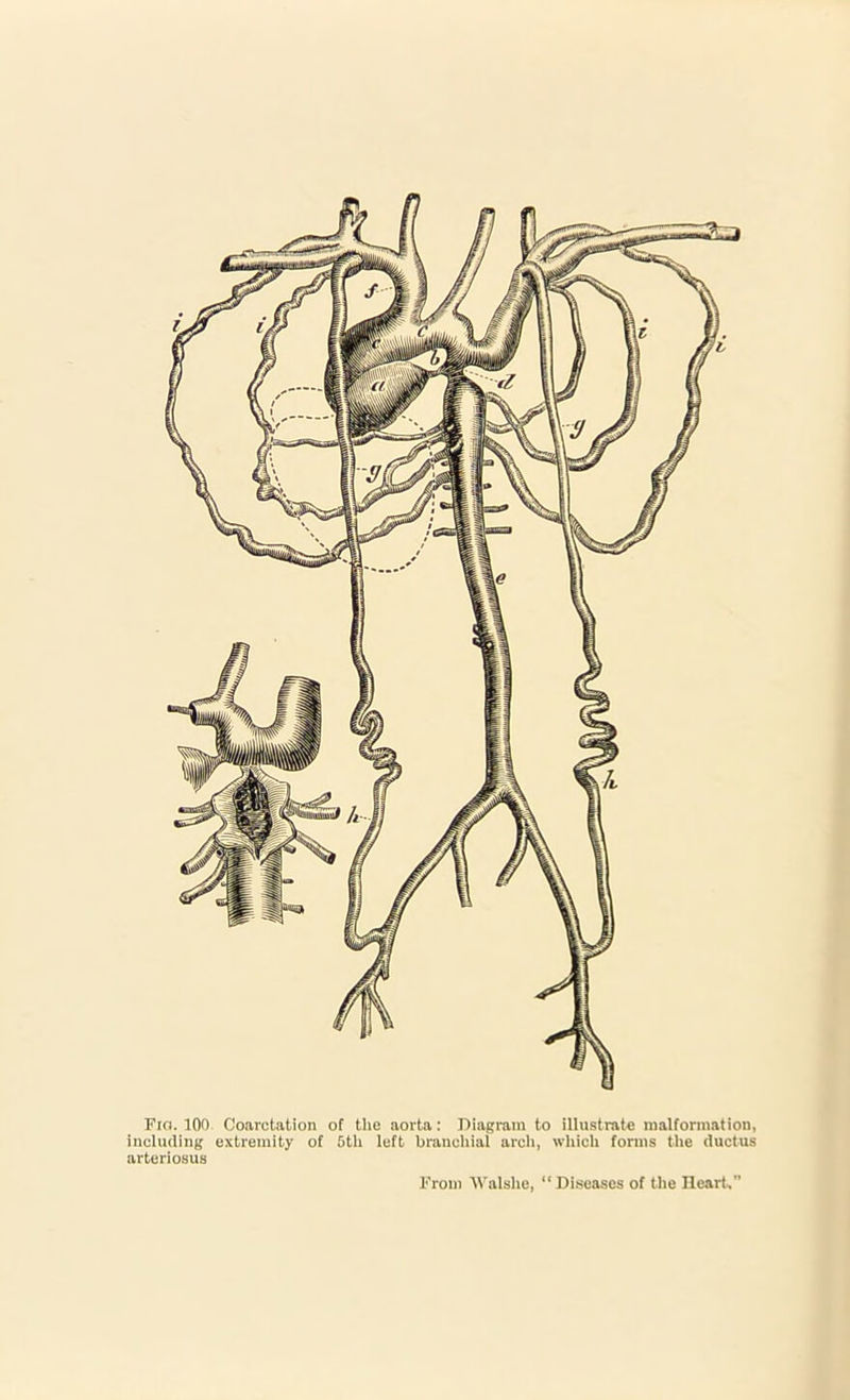 Fra. 100 Coarctation of the aorta: Diagram to illustrate malformation, including extremity of 5th left branchial arch, which forms the ductus arteriosus From Walshe, “Diseases of the Heart,