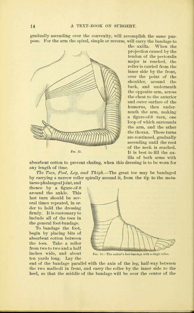 Fig. 17. gradually ascending over the convexity, will accomplish the same pur- pose. For the arm the spiral, simple or reverse, will carry the bandage to the axilla. When the projection caused by the tendon of the pectoralis major is reached, the roller is carried from the inner side by the front, over the point of the shoulder, around the back, and underneath the opposite arm, across the chest to the anterior and outer surface of the humerus, then under- neath the arm, making a figure-of-8 turn, one loop of which surrounds the arm, and the other the thorax. These turns are continued, gradually ascending until the root of the neck is reached. It is best to fill the ax- illa of both arms with absorbent cotton to prevent chafing, when this dressing is to be worn for any length of time. TJie Toes, Foot, Leg, and TMgJi.—The great toe may be bandaged by carrying a narrow roller spirally around it, from the tip to the meta- tarso-phalangeal Joint, and thence by a figure-of-8 around the ankle. This last turn should be sev- eral times repeated, in or- der to hold the dressing firmly. It is customary to include all of the toes in the general foot-bandage. To bandage the foot, begin by placing bits of absorbent cotton between the toes. Take a roller from two to two and a half inches wide, and about ten yards long. Lay the end of the bandage parallel with the axis of the leg, half-way between the two malleoli in front, and carry the roller by the inner side to the heel, so that the middle of the bandage will be over the center of the Fig. 18.—The author's foot-bandacre with a sins'le roller.