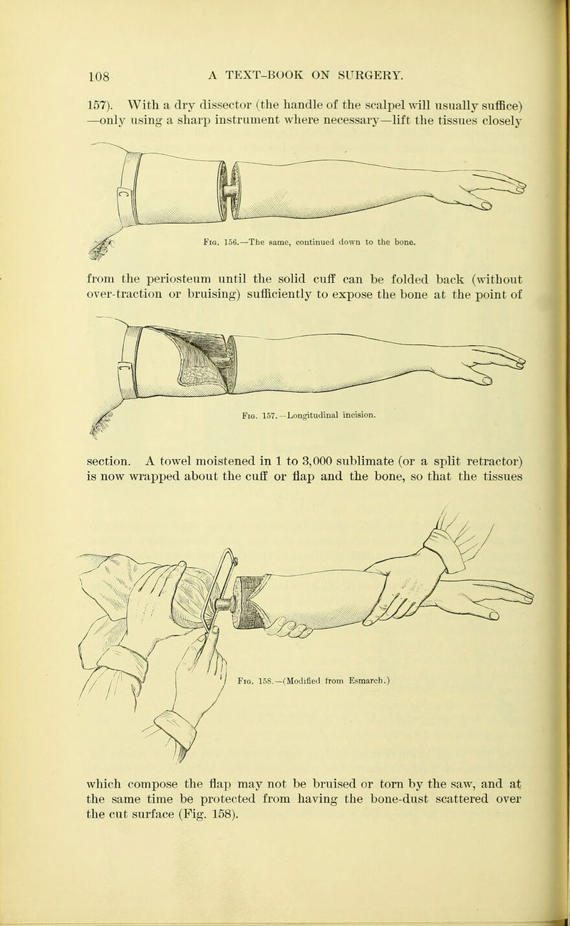 157). With a dry dissector (the handle of the scalpel wall usually suflSce) —only using a sharp instrument where necessary—lift the tissues closely from the periosteum until the solid cuff can be folded back (withoiit over-traction or bruising) sufficiently to expose the bone at the point of section. A towel moistened in 1 to 3,000 sublimate (or a split retractor) is now wrapped about the cuflE or flap and the bone, so that the tissues which compose the flap may not be bruised or torn by the saw, and at the same time be protected from having the bone-dust scattered over the cut surface (Fig. 158).
