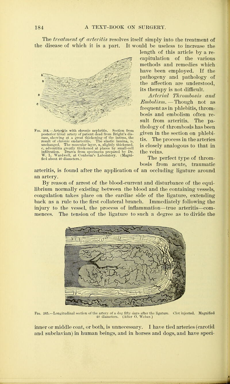 The treatment of arteritis resolves itself simply into the treatment of the disease of which it is a part. It would be useless to increase the length of this article by a re- capitulation of the various methods and remedies which have been employed. If the pathogeny and pathology of the atfection are understood, its therapy is not difficult. Arterial TTironibosis and Embolism. — Though not as frequent as in phlebitis, throm- bosis and embolism often re- sult from arteritis. The pa- thology of thrombosis has been given in the section on phlebi- tis. The process in the arteries is closely analogous to that in the veins. The perfect type of throm- bosis from acute, traumatic arteritis, is found after the application of an occluding ligature around an artery. By reason of arrest of the blood-current and disturbance of the equi- librium normally existing between the blood and the containing vessels, coagulation takes place on the cardiac side of the ligature, extending back as a rule to the first collateral branch. Immediately following the injury to the vessel, the process of inflammation—true arteritis—com- mences. The tension of the ligature to such a degree as to divide the Fig. 264—Arteritis with chronic nephritis. Section from posterior tibial artery of patient dead from Bright's dis- ease, showing at a great thickening of the intima, the result of chronic endarteritis. The elastic lamina, d, unchanged. The muscular layer, b, slightly thickened, c, adventitia greatly thickened at places by small-cell infiltration. Drav/n from specimens prepared by Dr. W. L. Wardwell, at Conheim's Laboratory, fied about 40 diameters.) Fig. 265.—Longitudinal section of the artery of a dog fifty days after the ligature. Clot injected. Magnified 40 diameters, (After O. Weber.) inner or middle coat, or both, is unnecessary. I have tied arteries (carotid and subclavian) in human beings, and in horses and dogs, and have speci-