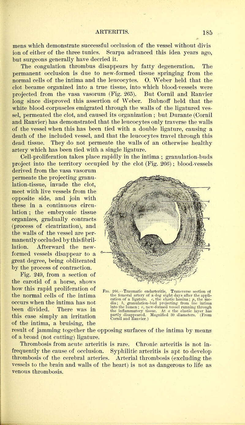 mens which demonstrate successful occlusion of the vessel without divis ion of either of the three tunics. Scarpa advanced this idea years ago, but surgeons generally have decried it. The coagulation thrombus disappears by fatty degeneration. The permanent occlusion is due to new-formed tissue springing from the normal cells of the intima and the leucocytes. 0. Weber held that the clot became organized into a true tissue, into which blood-vessels were projected from the vasa vasorum (Fig. 265). But Cornil and Ranvier long since disproved this assertion of Weber. Bubnoff held that the white blood-corpuscles emigrated through the walls of the ligatured ves- sel, permeated the clot, and caused its organization ; but Durante (Cornil and Ranvier) has demonstrated that the leucocytes only traverse the walls of the vessel when this has been tied with a double ligature, causing a death of the included vessel, and that the leucocytes travel through this dead tissue. They do not permeate the walls of an otherwise healthy artery which has been tied with a single ligature. Cell-proliferation takes place rapidly in the intima ; granulation-buds project into the territory occupied by the clot (Fig. 266); blood-vessels derived from the vasa vasorum permeate the projecting granu- lation-tissue, invade the clot, meet with live vessels from the opposite side, and join with these in a continuous circu- lation ; the embryonic tissue organizes, gradually contracts (process of cicatrization), and the walls of the vessel are per- manently occluded by this fibril- lation. Afterward the new- formed vessels disappear to a great degree, being obliterated by the process of contraction. Fig. 249, from a section of the carotid of a horse, shows how this rapid proliferation of the normal cells of the intima occurs when the intima has not been divided. There was in this case simply an irritation of the intima, a bruising, the result of jamming together the opposing surfaces of the intima by means of a broad (not cutting) ligature. Thrombosis from acute arteritis is rare. Chronic arteritis is not in- frequently the cause of occlusion. Syphilitic arteritis is apt to develop thrombosis of the cerebral arteries. Arterial thrombosis (excluding the vessels to the brain and walls of the heart) is not as dangerous to life as venous thrombosis. Fig. 266.—Traumatic endarteritis. Transverse section of the femoral artery of a dog eight days after the appli- cation of a ligature. «, the elastic lamina; p, the me- dia; J, granulation-bud projecting from the intima into the lumen ; new-formed vessel running through the inflammatory tissue. At a the elastic layer has partly disappeared. Magnified 30 diameters. (From Cornil and Kanvier.)