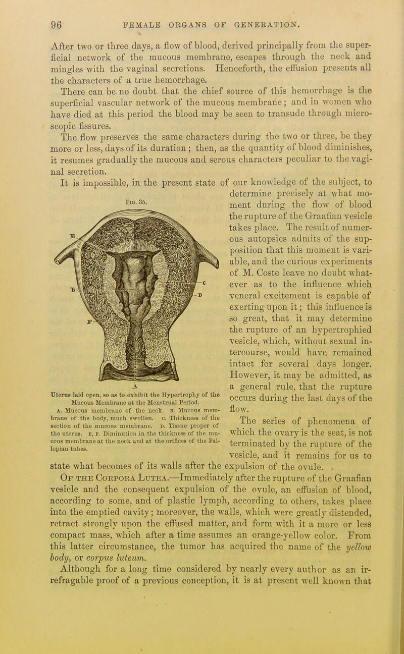 After two or three days, a flow of blood, derived principally from the super- ficial network of the mucous membrane, escapes through the neck and mingles with the vaginal secretions. Henceforth, the effusion presents all the characters of a true liemorrhage. There can be no doubt that the chief source of this hemorrhage is the superficial vascular network of the mucous membrane; and in women who have died at this period the blood may be seen to transude through micro- scopic fissures. The flow preserves the same characters during the two or three, be they more or less, days of its duration; then, as the quantity of blood diminishes, it resumes gradually the mucous and serous characters peculiar to the vagi- nal secretion. It is impossible, in the present state of our knowledge of the subject, to determine precisely at what mo- ment during the flow of blood the rupture of the Graafian vesicle takes place. The result of numer- ous autopsies admits of the sup- position that this moment is vari- able, and the curious experiments of M. Coste leave no doubt what- ever as to the influence which veneral excitement is capable of exerting upon it; this influence is so great, that it may determine the rupture of an hypertrophied vesicle, which, without sexual in- tercourse, would have remained intact for several days longer. However, it may be admitted, as a general rule, that the rupture occurs during the last days of the flow. The series of phenomena of which the ovary is the seat, is not terminated by the rupture of the vesicle, and it remains for us to state what becomes of its walls after the expulsion of the ovule. . Op the Corpora Lxjtea.—Immediately after the rupture of the Graafian vesicle and the consequent expulsion of the ovule, an effusion of blood, according to some, and of plastic lymph, according to others, takes place into the emptied cavity; moreover, the walls, which were greatly distended, retract strongly upon the effiised matter, and form with it a more or less compact mass, which after a time assumes an orange-yellow color. From this latter circumstance, the tumor has acquired the name of the yellow body, or corpus luteum. Although for a long time considered by nearly every author as an ir- refragable proof of a previous conception, it is at present well known that Utenis laid open, so as to exhibit the Hypertrophy of the Mucous Membrane at the Menstrual Period. A. Mucous membrane of tlie neck. B. Mucous mem- brane of the body, much swollen, c. Tbicltness of the section of ilie mucous membrane. B. Tissue proper of the uterus. E, F. DiminiUion in the thickness of the mu- cous membrane at the neck and at the orifices of the Fal- lopian tubes.