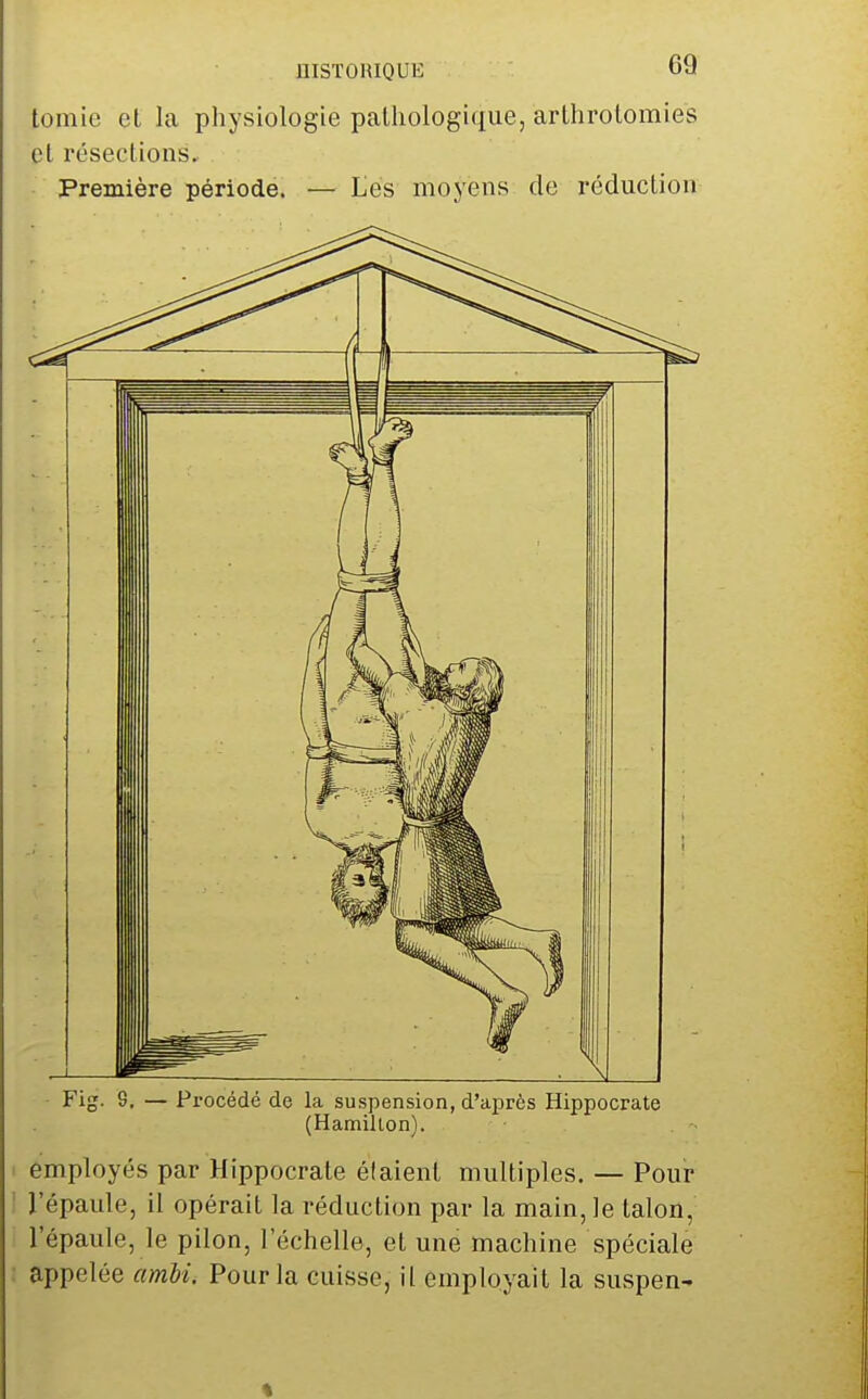 tomie et la physiologie paUiologi(tue, arlhrolomies et résections. Première période. — Les moyens de réduction Fig. 9, — Procédé de la suspension, d'ai^rès Hippocrate (Hamillon). employés par Hippocrate étaient multiples. — Pour l'épaule, il opérait la réduction par la main, le talon, l'épaule, le pilon, l'échelle, et une machine spéciale appelée amU. Pour la cuisse, il employait la suspen-