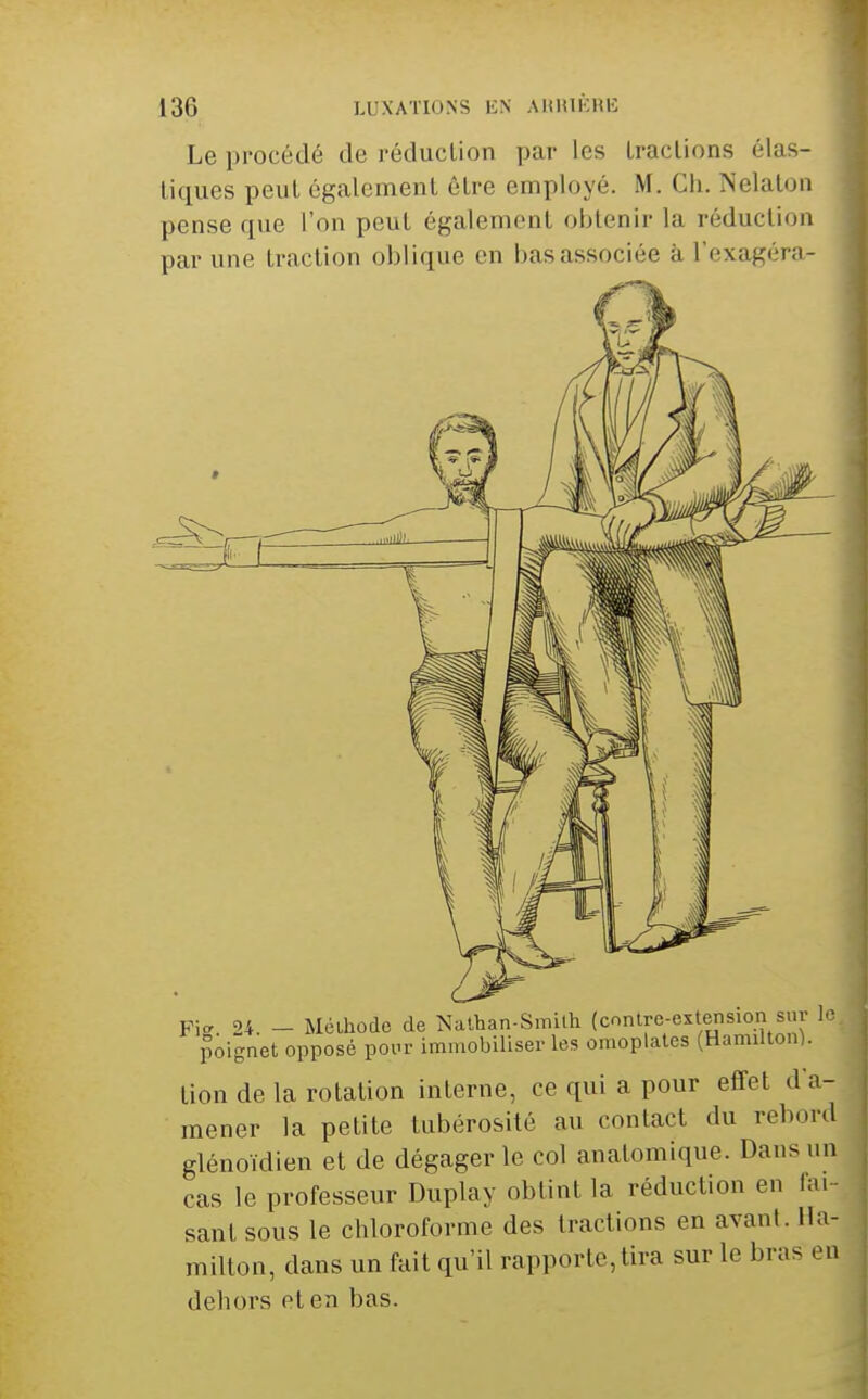 Le procédé de réducUon par les Lraclions élas- tiques peut également être employé. M. Ch. INelaton pense que l'on peut également obtenir la réduction par une traction oblique en bas associée à l'exagéra- Fi 24 - Méihûdo de Nalhan-Smilh (contre-extension sur poignet opposé pour immobiliser les omoplates (Hamilton). tion de la rotation interne, ce qui a pour effet d'a- mener la petite tubérosité au contact du rebord glénoïdien et de dégager le col anatomique. Dans un cas le professeur Duplay obtint la réduction en iai saut sous le chloroforme des tractions en avant. Ha- milton, dans un fait qu'il rapporte, tira sur le bras en dehors et en bas. Il