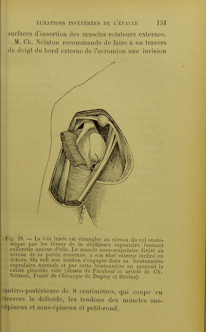 surfaces d'insertion des muscles rolaleurs externes. M. Ch. Nélaton recommande de faire à un travers de doigt du bord externe de l'acromion une incision IFig. 28. — La tète luxée est étranglée au niveau du col anato- mique par les lèvres de la déchirure capsulaire formant collerette autour d'elle. Le muscle sous-scapulaire divisé au niveau de sa partie moyenne, a son chef externe incliné en dehors. On voit son tendon s'engager dans sa boutonnière capsulaire normale et par cette boutonnière on aperçoit la cavité glénoïdc vide (dessin de Farabcuf in article dé Ch. Nélaton, Traité de Chirurgie de Duplay et Reclus). lantéro-postérieure de 8 centimètres, qui coupe en (travers le deltoïde, les tendons des muscles sus- 'épineux et sous-épineux et petit-rond.