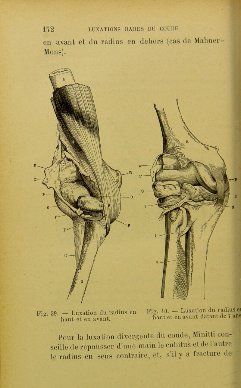 en avant el du radius en dehors (cas de Mahner- Mons). Pour la luxation divergente du coude, Minitti con- seille de repousser d'une main le cubitus eldo l'autre le radius en sens contraire, et, s'il y a fracture de