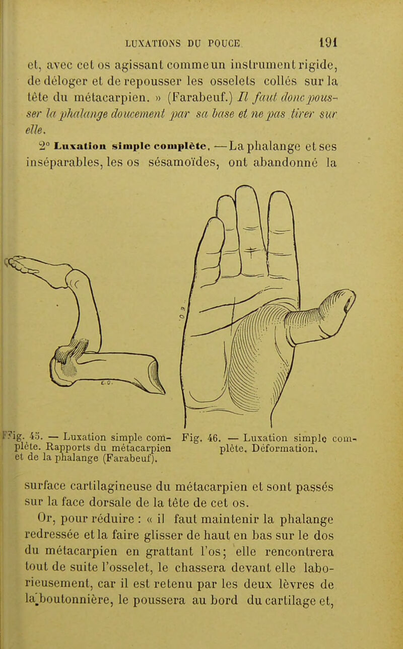 cl, avec cet os agissant comme un inslrumont rigide, de déloger et de i-epousser les osselets collés sur la tête du métacarpien. » (Farabeuf.) Il faut donc pous- ser la phalange doucement par sa base et ne pas tirer sur elle. 2° Luxation simple complète. —La phalange et SCS inséparables, les os sésamoïdes, ont abandonné la Fng. 43. — Luxation simple com- Fig. 46. — Luxation simple corn pléte. Rapports du métacarpien plète. Déformation, et de la phalange (Farabeuf). surface cartilagineuse du métacarpien et sont passés sur la face dorsale de la tête de cet os. Or, pour réduire : « il faut maintenir la phalange redressée et la faire glisser de haut en bas sur le dos du métacarpien en grattant l'os; elle rencontrera tout de suite l'osselet, le chassera devant elle labo- rieusement, car il est retenu par les deux lèvres de laj_boutonnière, le poussera au bord du cartilage cl.