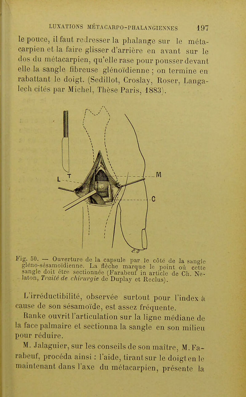 le pouce, il faut redresser la phalange sur le méta- carpien et la faire glisser d'arrière en avant sur le dos du métacarpien, qu'elle rase pour pousser devant elle la sangle fibreuse glénoïdienne ; on termine en rabattant le doigt. (Sedillot, Croslay, Roser, Langa- lecli cités par Michel, Thèse Paris, 18831. Pig. 50. — Ouverture) de la capsule par Je côté de la sangle gleno-sésamoïdienne. La flèche marque le point où cette sangle doit être sectionnée (Farabeuf in article de Ch Ne- laton, Trailéde chirurgie de Duplay et Reclus). L'irréductibilité, observée surtout pour l'index à cause de son sésamoïde, est assez fréquente. Ranke ouvrit l'articulation sur la ligne médiane de la face palmaire et sectionna la sangle en son milieu pour réduire. M. Jalaguier, sur les conseils de son maître, M. Fa- rabeuf, procéda ainsi : l'aide, tirant sur le doigt en lo maintenant dans l'axe du métacarpien, présente la