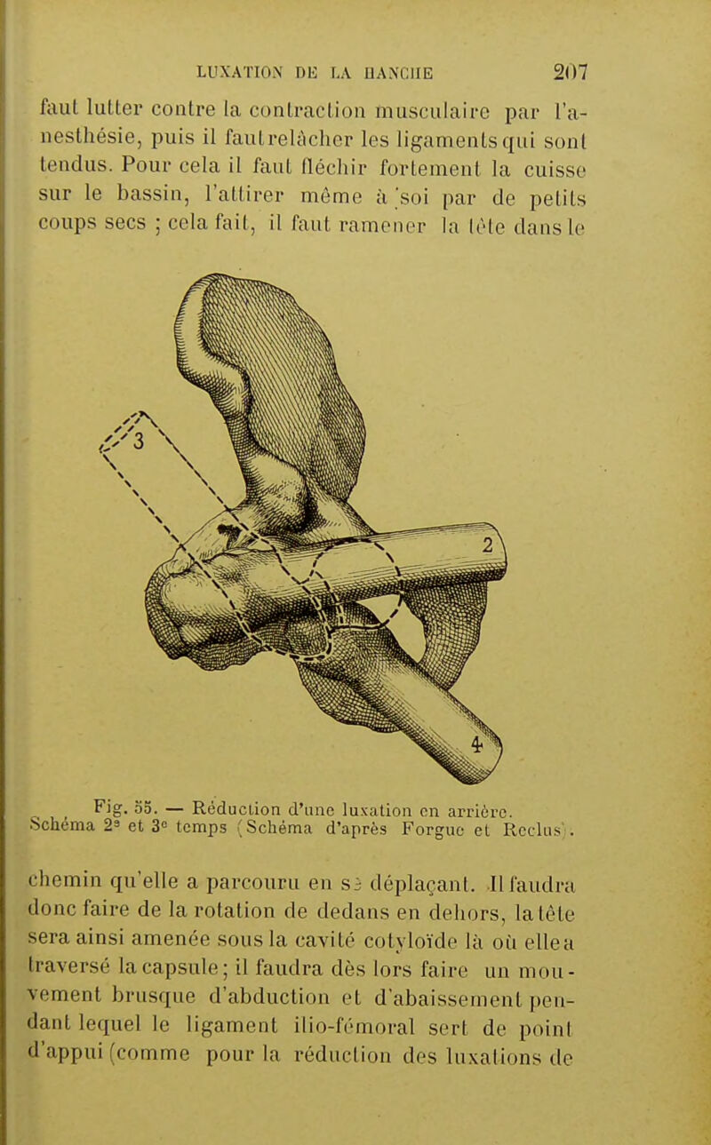 faut lutter contre la contraction musculaire par l'a- nesthésie, puis il fautrelticher les ligaments qui sont tendus. Pour cela il faut fléchir fortement la cuisse sur le bassin, l'attirer môme à soi par de petits coups secs ; cela fait, il faut ramener la lèle dans le Fig. o5. — Réduction d'une luxation on arrière. Schéma 2^ et S temps (Schéma d'après Forguc et Reclus'. chemin qu'elle a parcouru en s3 déplaçant. Il faudra donc faire de la rotation de dedans en dehors, la tête sera ainsi amenée sous la cavité cotyloïde là où elle a traversé la capsule ; il faudra dès lors faire un mou - vement brusque d'abduction et d'abaissement pen- dant lequel le ligament ilio-fémoral sert de point d'appui (comme pour la réduction des luxations de