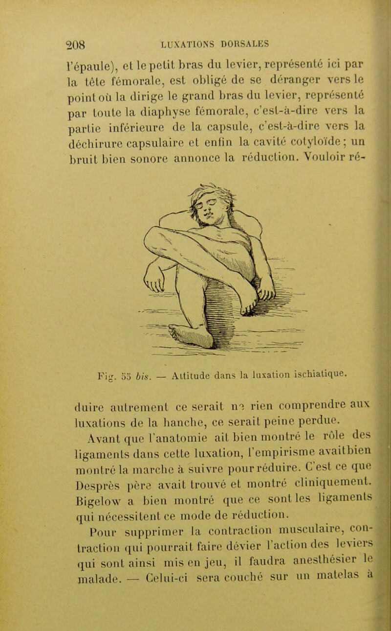 l'épaule), et lepelil bras du levier, représenté ici par la tète fémorale, est obligé de se déranger vers le point où la dirige le grand bras du levier, représenté par toute la diaphyse fémorale, c'est-à-dire vers la partie inférieure de la capsule, c'est-à-dire vers la déchirure capsulaire et enfin la cavité cotyloïde; un bruit bien sonore annonce la réduction. Vouloir ré- Fig. 00 bis. — Altitude dans la luxation ischialique. duire autrement ce serait n-î rien comprendre aux luxations de la hanche, ce serait peine perdue. Avant que l'anatomie ait bien montré le rôle des ligaments dans cette luxation, l'empirisme avaitbien montré la marche à suivre pour réduire. C'est ce que Desprès père avait trouvé et montré cliniquement. Bigelow a bien montré que ce sont les ligaments qui nécessitent ce mode de réduction. Pour supprimer la contraction musculaire, con- traction qui pourrait faire dévier l'action des leviers qui sont ainsi mis en jeu, il faudra aneslhésier h' malade. — Celui-ci sera couché sur un matelas à