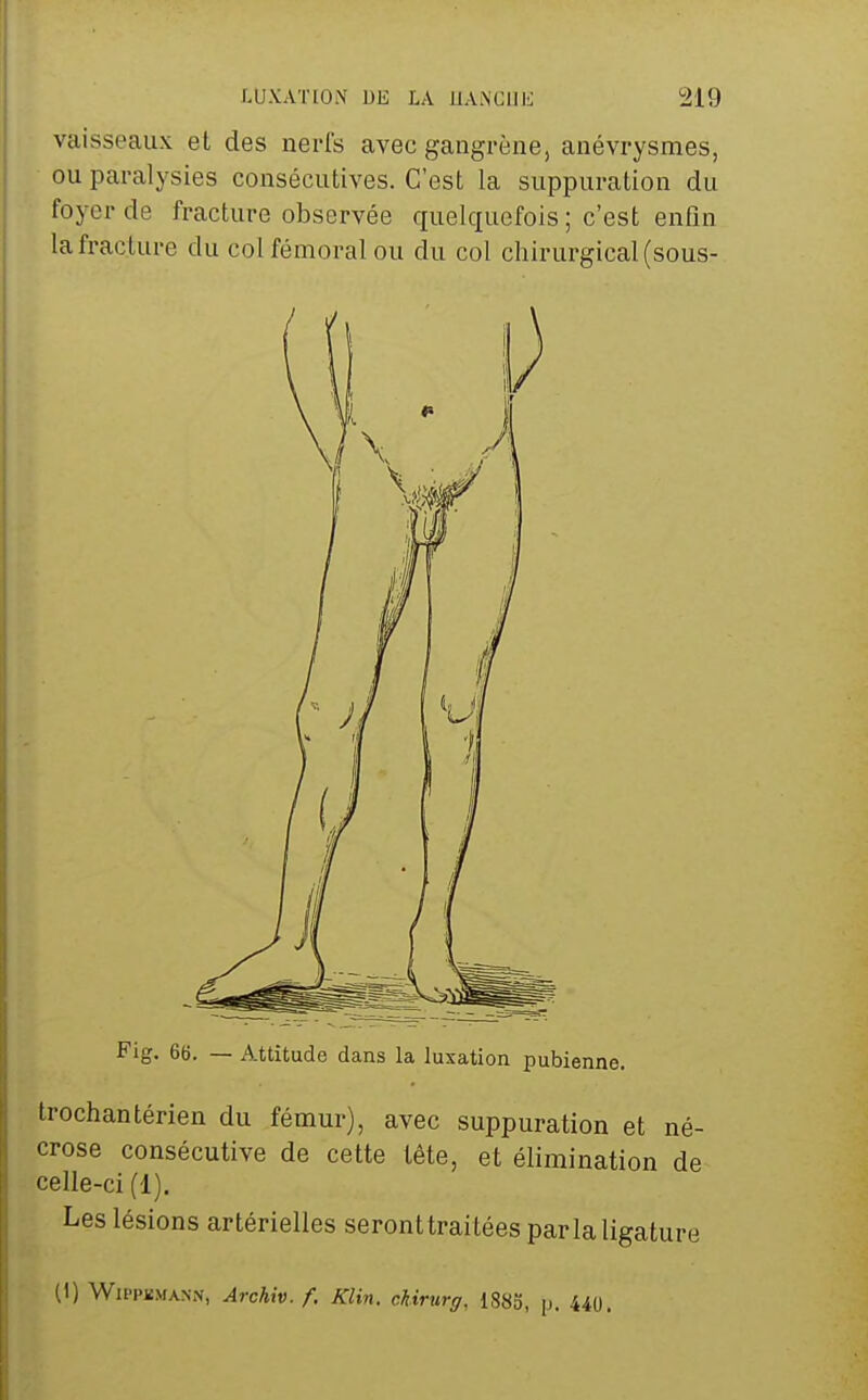 vaisseaux et des nerfs avec gangrène, anévrysmes, ou paralysies consécutives. C'est la suppuration du foyer de fracture observée quelquefois; c'est enfin la fracture du col fémoral ou du col chirurgical (sous- Fig. 66. — A.ttîtude dans la luxation pubienne. trochantérien du fémur), avec suppuration et né- crose consécutive de cette tête, et élimination de celle-ci (1). Les lésions artérielles seronttraitées parla ligature (1) Wu'PKMANN, Arckiv. f. Klin. cUrurg, 1883, p. 44U.