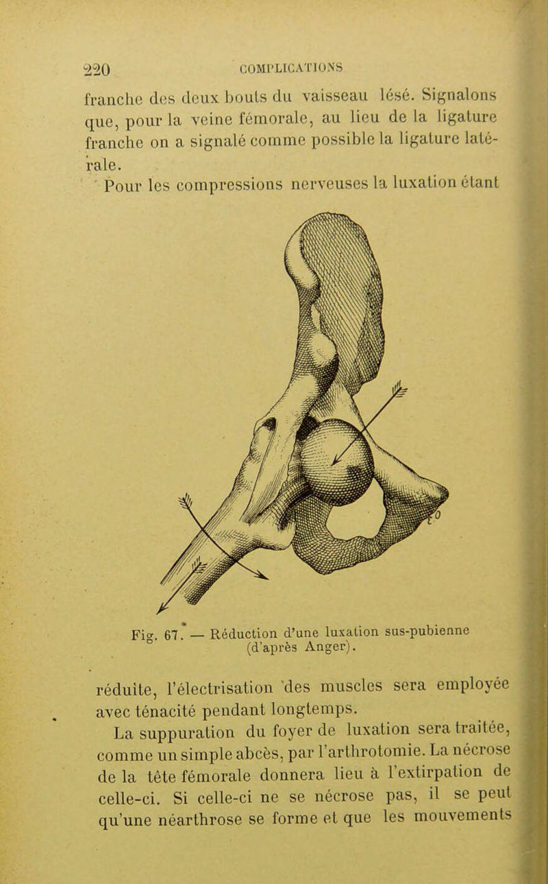 ^20 COMPLICATIONS franche des deux bouls du vaisseau lésé. Signalons que, pour la veine fémorale, au lieu de la ligature franche on a signalé comme possible la ligature laté- rale. Pour les compressions nerveuses la luxation étant Fio-. 67.— Réduction d'une luxation sus-pubienne ° (d'après Anger). réduite, l'électrisation des muscles sera employée avec ténacité pendant longtemps. La suppuration du foyer de luxation sera traitée, comme un simple abcès, par l'arthrolomie. La nécrose de la tête fémorale donnera lieu à l'extirpation de celle-ci. Si celle-ci ne se nécrose pas, il se peut qu'une néarthrose se forme et que les mouvements