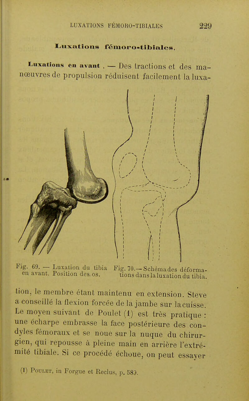 r.ux.ations fénioro-tlbiales. Luxations en avant . — Des tractions et des ma- nœuvres de propulsion réduisent facilement la luxa- tion, le membre étant maintenu en extension. Steve a conseillé la flexion forcée de la jambe sur lacuisse. Le moyen suivant de Poulet (1) est très pratique : une écharpe embrasse la face postérieure des con- dyles fémoraux et se noue sur la nuque du chirur- gien, qui repousse à pleine main en arrière l'extré- mité libiale. Si ce procédé échoue, on peut essayer (I) Poulet, in Forgue et Reclus, p. 589.