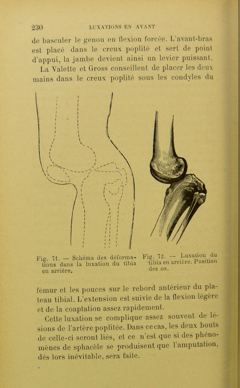 -230 LUXATIONS EN AVANT de basculer le genou en flexion forcée. L'avanl-bras esl placé dans le creux poplilé el sert de point d'appui, la jambe devient ainsi un levier puissant. La Valette et Gross conseillent de placer les deux mains dans le creux poplité sous les condyles du Fis. - Schéma des déforma- Fig. ~r>. - Luxation du tions dans la luxation du tibia tibia en arrière. Position en ai-rière. fémur el les pouces sur le rebord antérieur du pla- teau tibial. L'extension est suivie de la flexion légère et de la coaptation assez rapidement. Cette luxation se complique assez souvent de lé- sions de l'artère poplitée. Dans ce cas, les deux bouts de celle-ci seront liés, et ce n'est que si des phéno- mènes de sphacèle se produisent que l'amputation, dès lors inévitable, sera faite.