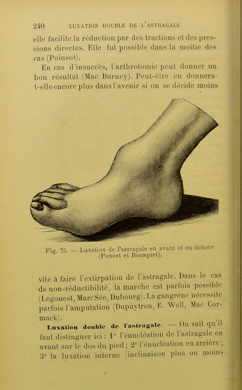 elle facilite la réduclion par des Iraclions et des pres- sions directes. Elle l'ut possible dans la moitié des cas (Poinsot). En cas d'insuccès, l'arthrotomie peut donner un bon résultat (Mac Burney). Peut-ôlre en donnera- t-elle encore plus dans l'avenir si on se décide moins Fio. ^5. _ Luxation de l'astragale en avant et en dehors  (Poncet et Bousquet). vite à faire l'extirpation de l'astragale. Dans le cas de non-réductibilité, la marche est parfois possible (Legouest,MarcSée,Dubourg). La gangrène nécessite parfois l'amputation (Dupuytren, E. Well, .Mac Cor- mack). Luxation double de l'astragale. — On sait qu il faut distinguer ici : 1 l'énucléation de l'astragale en avant sur le dos du pied ; 2 l'énucléation en arrière ; 3° la luxation interne (inclinaison plus ou moins