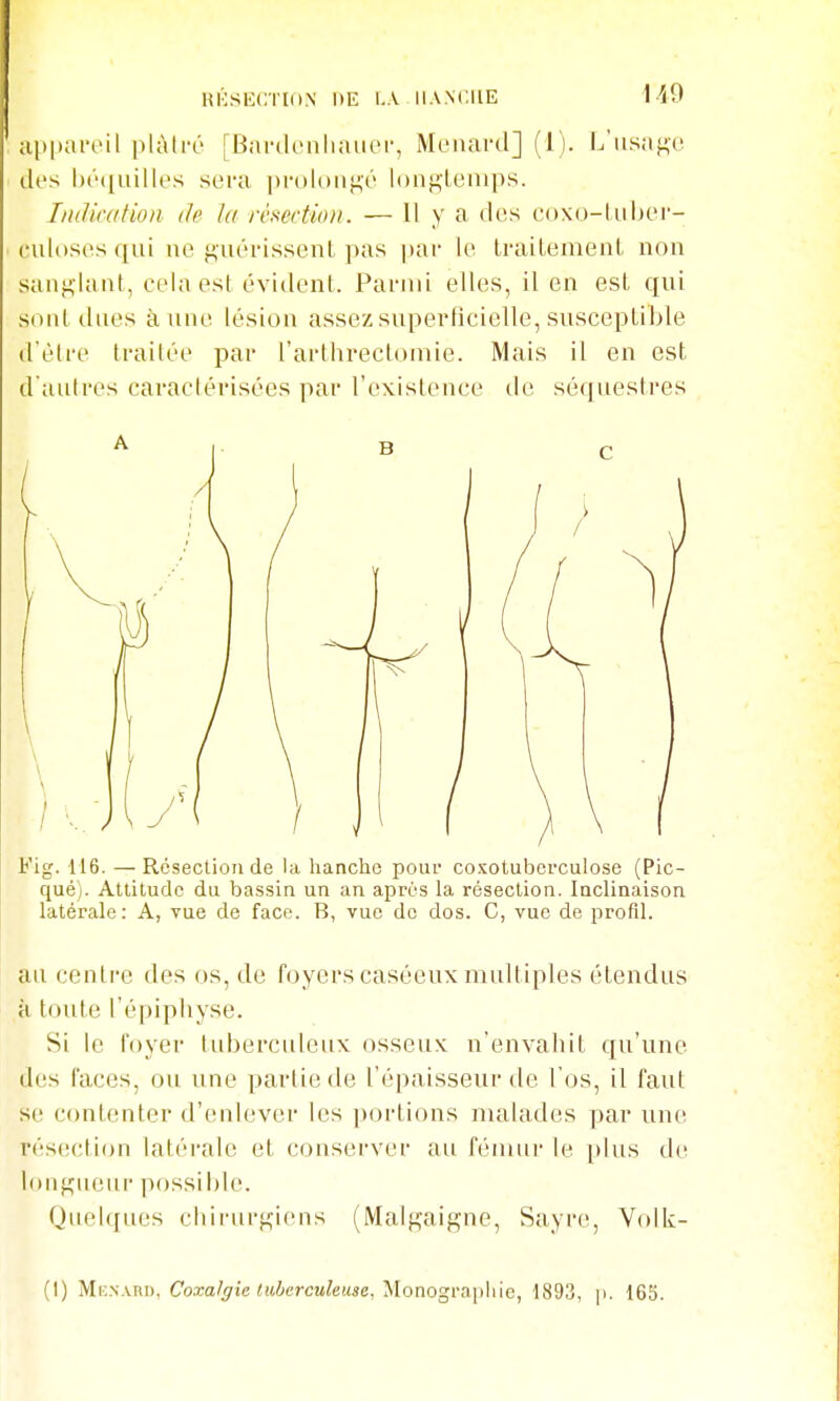 ai>|)areil pU\ti-o [Bardenliaiiei-, Menard] (1). lïiisaf^c des l)(''([uilles sera ])i-ol()iif^('' long'leinps. Indication de la résection. — Il y a des coxo-liiber- culoses qui ne guérissent pas par le traitement non sang-iant, cela est évident. Parmi elles, il en est qui sont dues aune lésion assez superficielle, susceptible d'être traitée par ['arthreclomie. Mais il en est d'autres caractérisées par l'existence de séquestres Fig. 116. —Résection de la hanche poui coxotuberculose (Pic- qué). Attitude du bassin un an après la résection. Inclinaison latérale: A, vue de face. B, vue do dos. C, vue de profil. au centre des os, de foyers caséeux multiples étendus à toute l'épiphyse. Si le foyer tuberculeux osseux n'envahit qu'une des faces, ou une partie de l'épaisseur de l'os, il faut se contenter d'enlever les portions malades par une rés(!ction latérale et conserver au fémur le plus de lonf^ueiir possible. Quelques chirurgiens (Malgaigne, Sayre, Volk- (1) Mi-.sxm), Coxa/ffie tuberculeuse, yLonogvayiUie, 1893, p. 165.