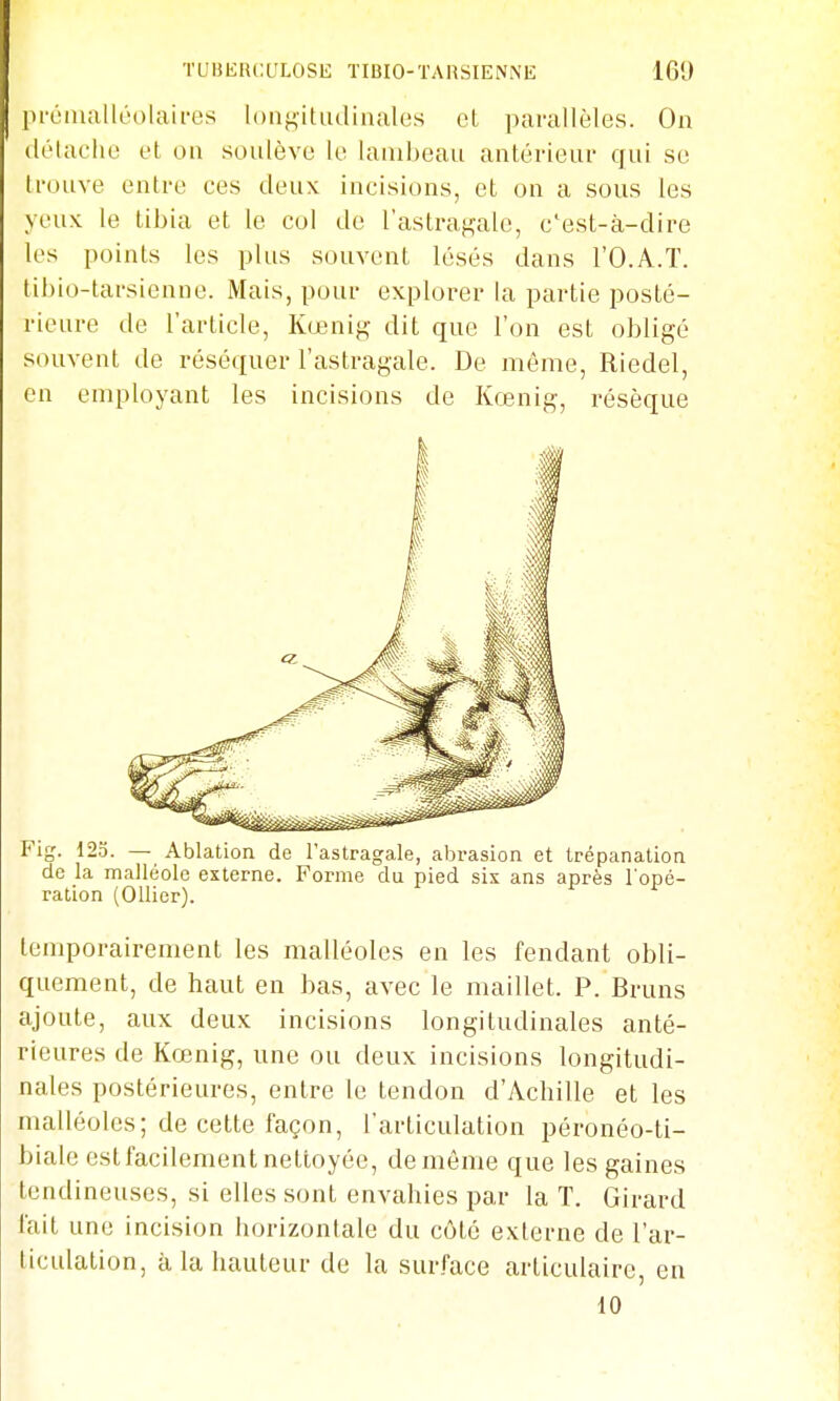 pcônialléolaires longitudinales et parallèles. On (lélaclu! et on soulève le lambeau antérieur qui se trouve entre ces deux incisions, et on a sous les yeux le tibia et le col de l'astragale, c'est-à-dire les points les plus souvent lésés dans l'O.A.T. tibio-tarsienne. Mais, pour explorer la partie posté- rieure de l'article, Kœnig dit que l'on est obligé souvent de réséquer l'astragale. De môme, Riedel, en employant les incisions de Kœnig, résèque Fig. 12o. — Ablation de l'astragale, abrasion et trépanation de la malléole externe. Forme du pied sis ans après l'opé- ration (Ollier). temporairement les malléoles en les fendant obli- quement, de haut en bas, avec le maillet. P. Bruns ajoute, aux deux incisions longitudinales anté- rieures de Kœnig, une ou deux incisions longitudi- nales postérieures, entre le tendon d'Achille et les malléoles; de cette façon, l'articulation péronéo-ti- biale estfacilement nettoyée, de même que les gaines tendineuses, si elles sont envahies par la T. Girard fait une incision horizontale du côté externe de l'ar- ticulation, à la hauteur de la surface articulaire, en 10