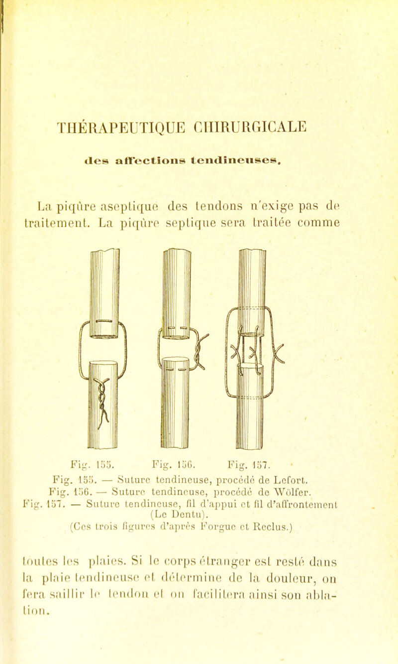 THÉRAPEUTIQUE CHIRURGICALE des affections tendineuses. La piqûre aseptique des tendons n'exige pas d(^ traitement. La piqûre septique sera traitée comme Fijr. 153. Fiy. 15G. Fig. lo7. Fig. IS.'j. — .Suture tendineuse, procodo de Lcfort. Fig. — Suture, tendineuse, procodé de WOlfer. Fig. 157. — Suture tendineuse, fil d'appui et fil d'ad'rontement (Le Dcntu). (Ces trois ligures d'a])rès {'orgue et Reclus.) foules les ])iaies. Si le corps étranger est resté dans la plaie IcndiiKuise et délenniiie de la douleur, on lera saillir le Icndon el on iacilittîra ainsi son abla- tion.