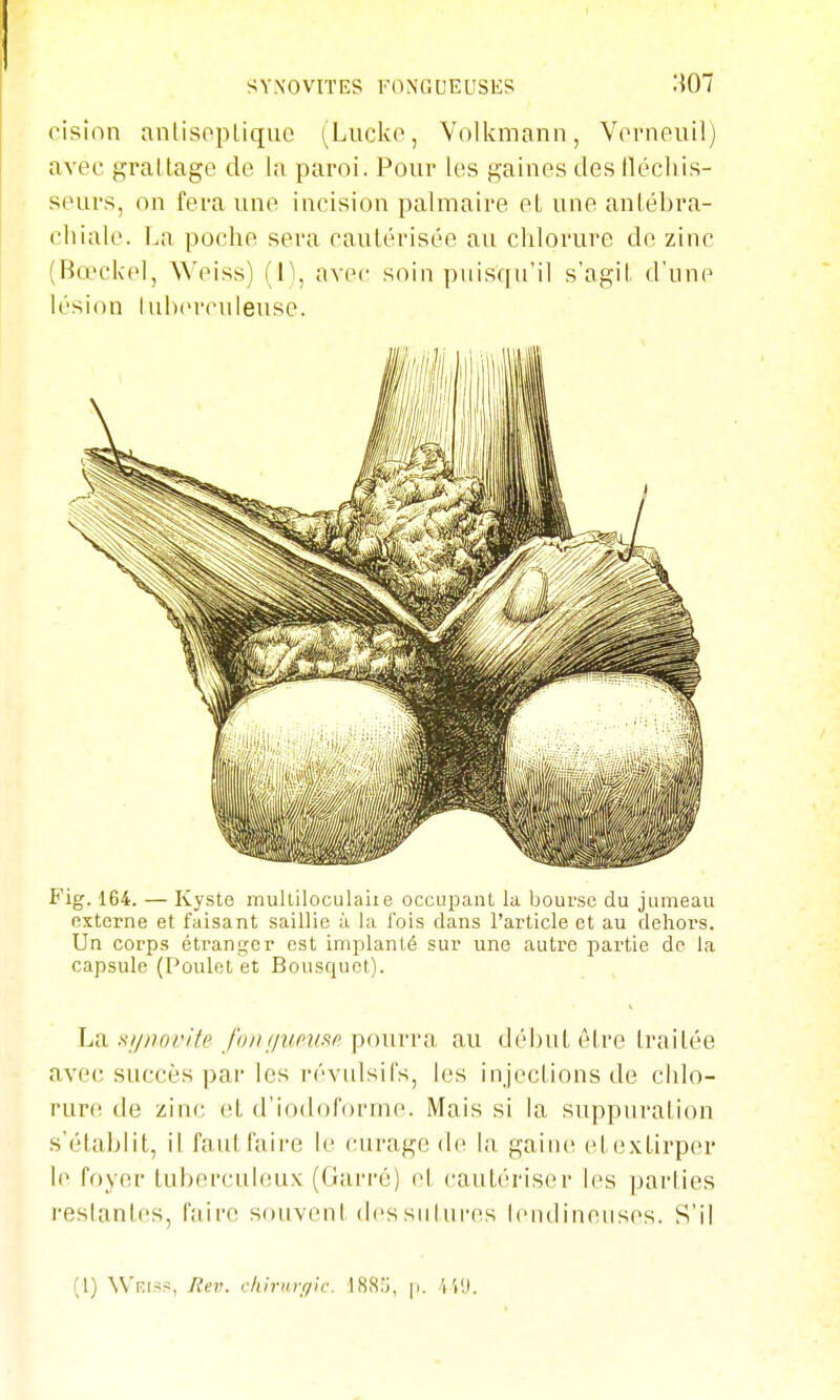 SV.NOVITES FONflUEUSES M07 cision anlisopLiquo (Lucko, Vnlkmann, Vornouil) avec grallage de la paroi. Pour les gaines des llécliis- seiu's, on fera une incision palmaire eL une anlébra- cliialo. i^a poche sera cautérisée au clilorure de zinc (Bœckel, Weiss) (l\ avec soin puisqu'il s'agit d'une lésion luherculeuse. Fig. 164. — Kyste multiloculaiie occuiDaiit la bourse du jumeau externe et faisant saillie à la fois clans l'article et au dehors. Un corps étranger est implanté sur une autre partie de la capsule (Pouletet Bousquet). hii s///ioi'/te Jh/i//uPi'Sf; poumi au débu t être traitée avec succès par les révulsifs, les injections de chlo- rure de zin(; ((l d'iodoforrne. Mais si la suppuration s'établit, il faut faire le curage de la gaine etextirper le foyer tuberculeux (Garré) et cautériser les parties restant(!S, faire souvent des sutures tendineuses. S'il