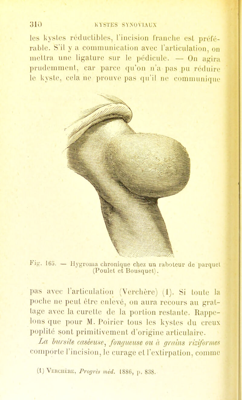 les kysLos réclu('LiJ)lcs, riiicisioii rranclie esL préfé- rable. S'il y a coiiiinuniealion avec l'arliculatiDii, on meltra une ligalurc sur le pédic'ule. — On agira pnideiiiineiil, car parce ([u'oii n'a pas ])u l'éclulrc le kysle. cela ne prouve pas f|ii'il ne connu unique Fvj:. 165. — IJygruuia chronique chez un rabolcur de pai-quel (Poulet et Bousquet). pas avec rarlicitlatiou (Verchèrc) (1). Si toute la poche ne peuL être enlevé, on aura recours au graL- lage avec la curelle de la portion restante. Rappe- lons que pour M. Poirier tous les kystes du creux poplité sont primilivement d'origine articulaire. La hursite aiséeu-se, fonijucim ou à grains riziformcs comporte l'incision, le curage et l'extirpation, connue (1) VEiiuiiimj, Progrès méd. 1886, p. 8:38.