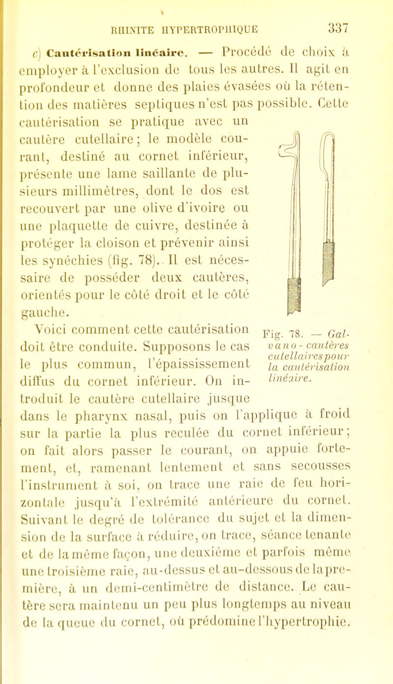 c) Cantérisation linéaire. — Procédé de clioix il employer à l'exclusion de tous les autres. Il agit en profondeur et donne des plaies évasées où la réten- tion des matières septiques n'est pas possible. Cette cautérisation se pratique avec un cautère cutellaire ; le modèle cou- rant, destiné au cornet inférieur, présente une lame saillante de plu- sieurs millimètres, dont le dos est recouvert par une olive d'ivoire ou une plaquette de cuivre, destinée à protéger la cloison et prévenir ainsi les synéchies (fig. 78). . Il est néces- saire de posséder deux cautères, orientés pour le côté droit et le côté gauche. Voici comment cette cautérisation doit être conduite. Supposons le cas le plus commun, l'épaississement diffus du cornet inférieur. On in- troduit le cautère cutellaire jusque dans le pharynx nasal, puis on l'applique à froid sur la partie la plus reculée du cornet inférieur; on fait alors passer le courant, on appuie forte- ment, et, ramenant lentement et sans secousses l'instrument à soi, on trace une raie de feu hori- zontale jusqu'à l'extrémité antérieure du cornet. Suivant le degré de tohjrance du sujet et la dimen- sion de la surface à réduire, on trace, séance tenante et de lamèmc façon, une deuxième et parfois même une troisième raie, au-dessus et au-dessous de lapre- mière, à un demi-centimètre de distance. Le cau- tère sera maintenu un peu plus longtemps au niveau de la queue du cornet, où prédomine l'hypertrophie. Fig. 78. — Gai- vano - cautères culellairespour la caulérisalion linéaire.