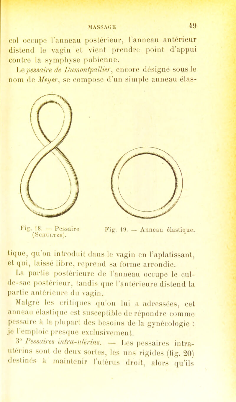 col occupe l'anneau postérieur, l'anneau antérieur distend le vagin et vient prendre point d'appui contre la symphyse pubienne. Lepessaire de Dumonipallier^ encore désigné sous le nom de Mei/er, se compose d'un simple anneau élas- Fig. 18. — Pcssaire Fig. lU. — Anneau élastique. (Scrici/rzis). tique, qu'on introduit dans le vagin en l'aplatissant, et qui, laissé libre, reprend sa forme arrondie. La partie postérieure de l'anneau occupe le cul- de-sac postérieur, landis ([ue ranléricure distend la partie aniérieui'c du vagin. Malgré les eriti([ii('s (ju'on lui a adressées, cet ;iiine.'iu élasli(|ii(' est susceptible de répondre comme [)essain! à la |)liipart des besoins de la gynécologie : j(! rem|)l()ie presque exclusivement. PesHdireis iiitra-ulèrins. — Les jtcssaii'es intra- utérins .s(ud (1(1 deux sortes, les uns rigides (tig. 20) deslinés à mainlenir l'utérus droit, alors ifu'ils